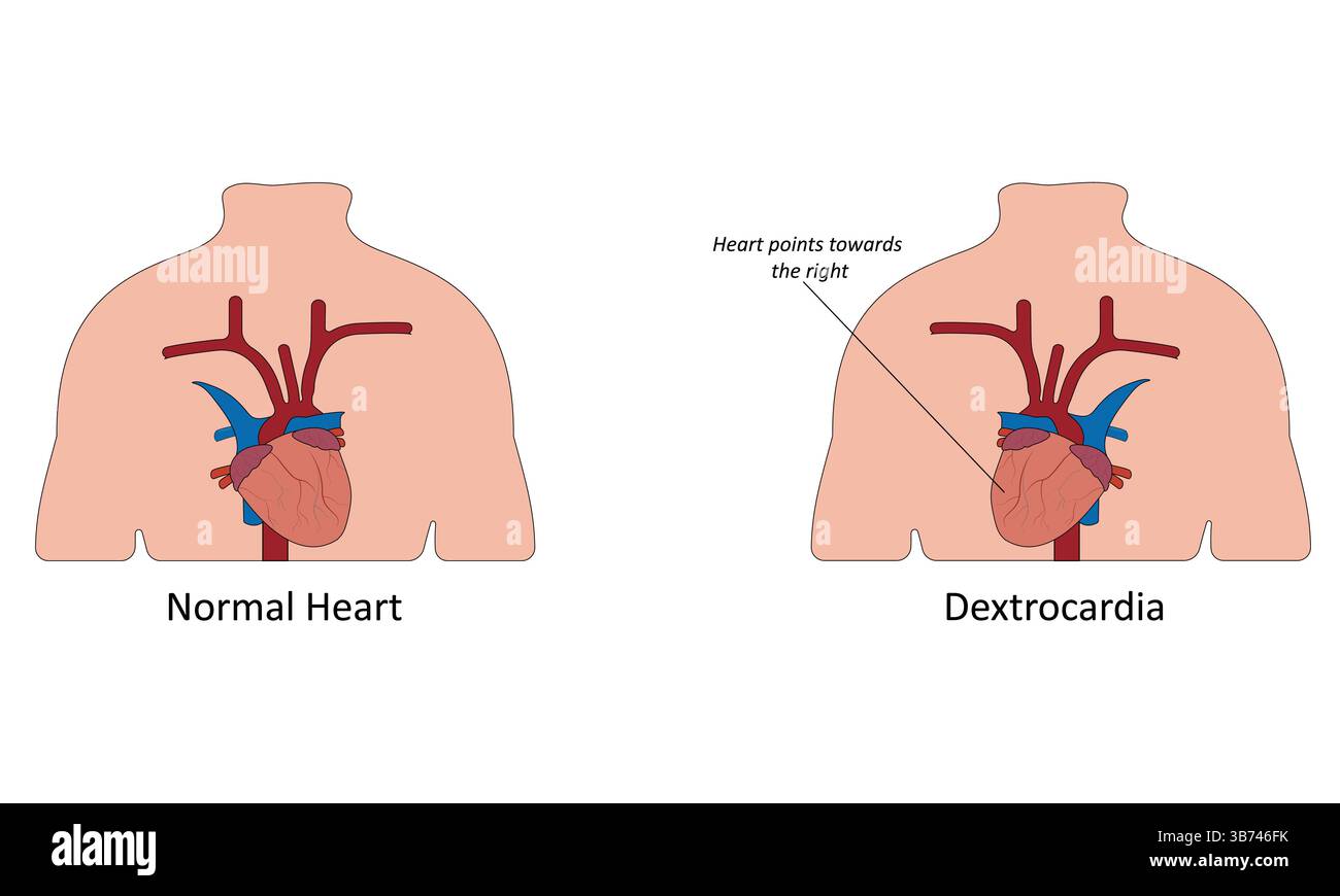 Illustrazione del vettore di destrocardia Illustrazione Vettoriale
