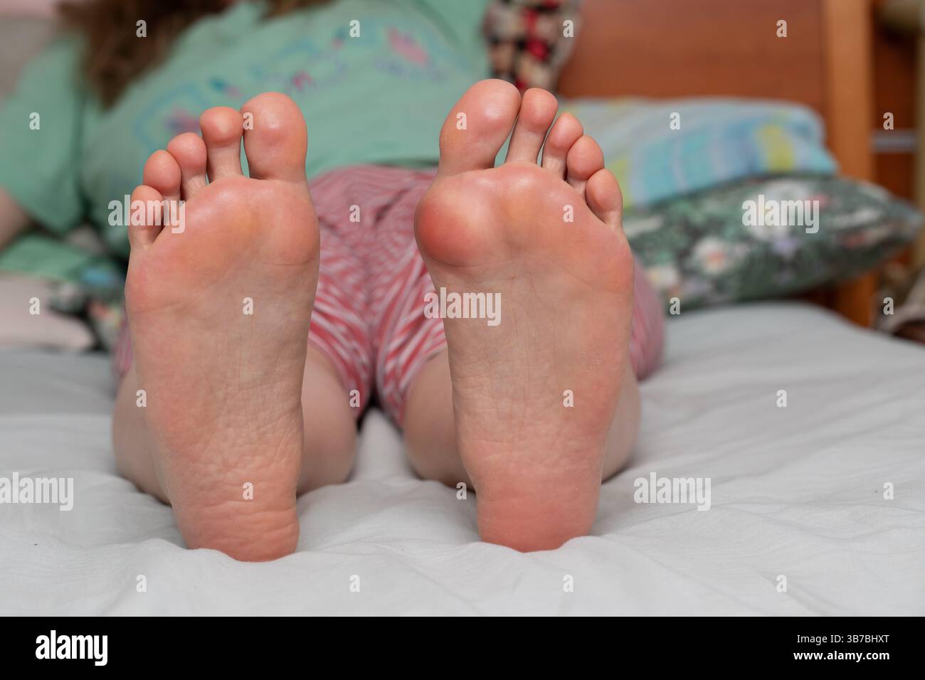 Persona sdraiata sul letto con suole di piedi che mostrano allux valgus Foto Stock
