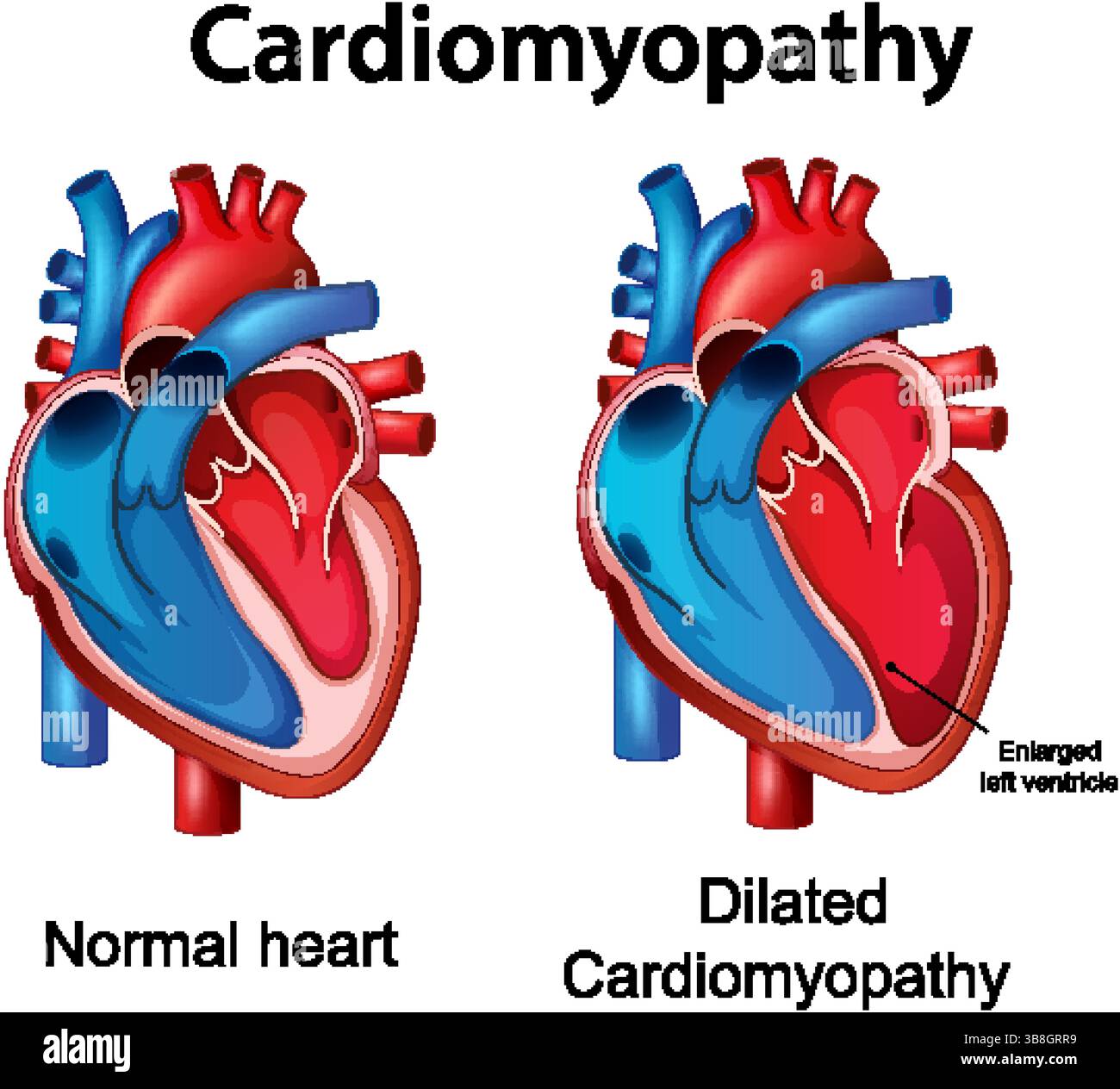 Illustrazione vettoriale che mostra un cuore normale e uno con cardiomiopatia dilatata, evidenziando le differenze anatomiche e il ventricolo sinistro ingrandito Illustrazione Vettoriale