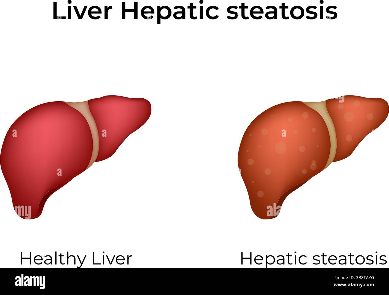 Illustrazione vettoriale di disegno per il confronto della steatosi epatica Illustrazione Vettoriale