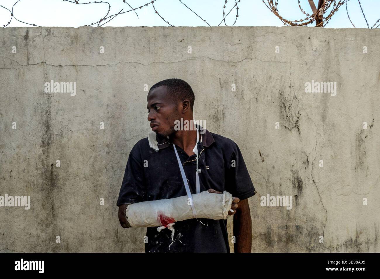 1° marzo 2020, Conakry, Conakry, Guinea: Youssouf Bah, un operaio della lamiera nel distretto di Wanindara dice di aver ricevuto un proiettile sparato dalla polizia mentre lavorava nel suo laboratorio... da metà ottobre, la capitale della Guinea vive al ritmo delle scene di guerriglia urbana tra giovani dimostranti del fronte Nazionale per la difesa della Costituzione e la polizia. Protestano contro la volontà del presidente Alpha Conde di candidarsi per un terzo mandato cambiando la Costituzione. Almeno trenta persone sono morte negli scontri dalla fine del 2019 (Credit Image: © S Foto Stock