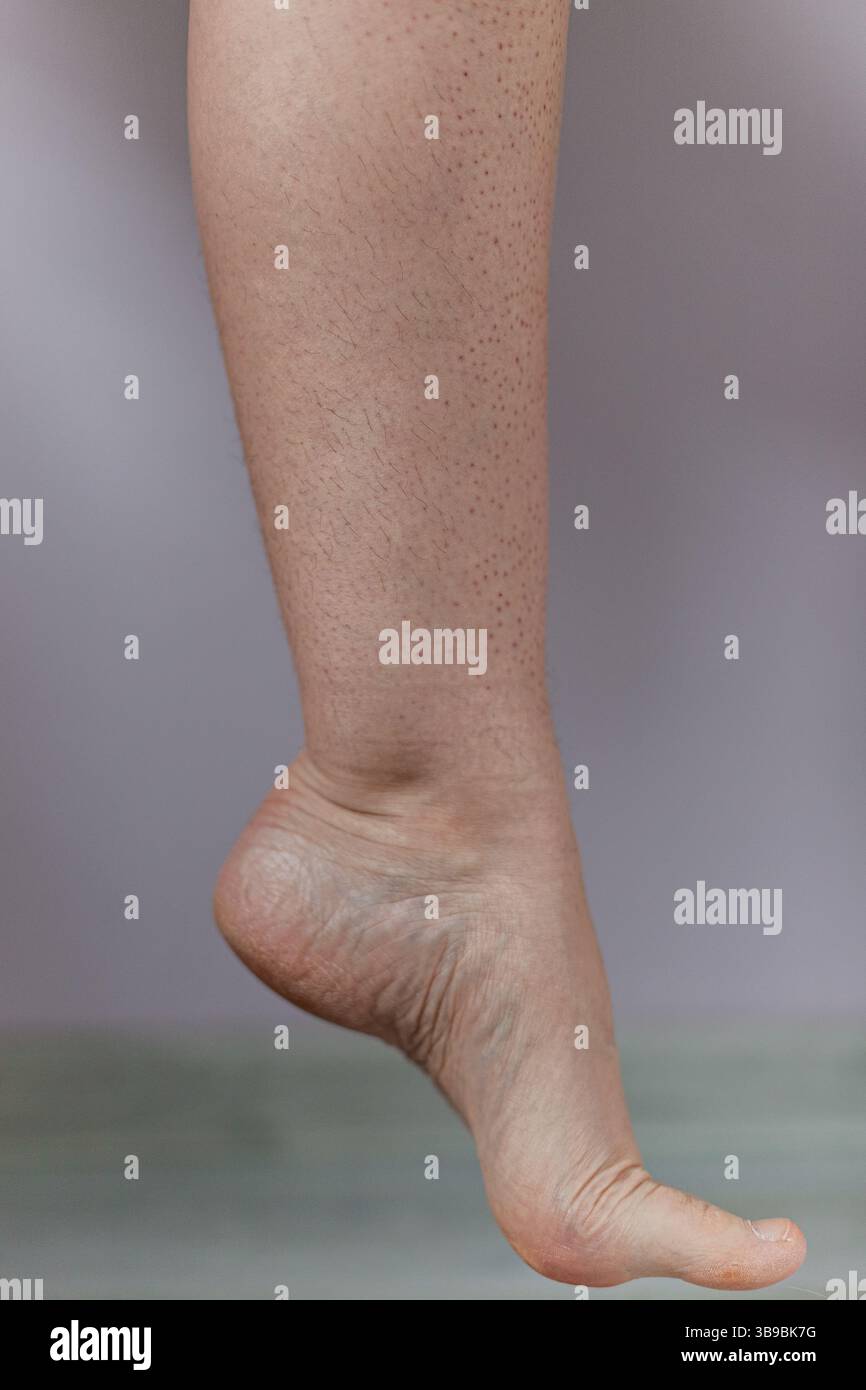 Primo piano della gamba femminile dopo l'epilazione, con rash visibile, rossore e peli parziali, irritazione della pelle e secchezza mostrati nei dettagli. Foto Stock