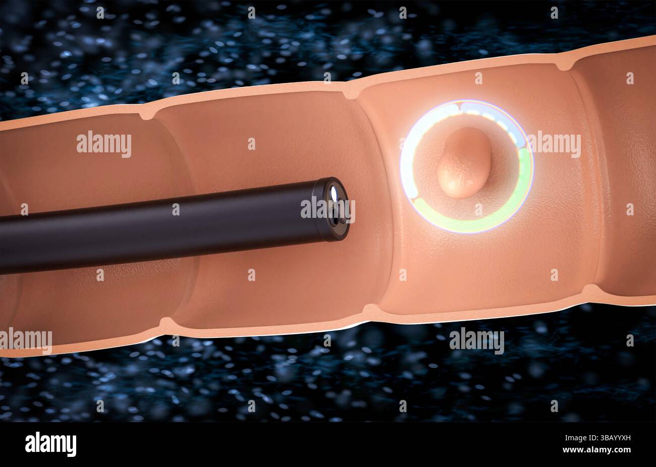 endoscopio di rendering 3d con polipo del colon nell'intestino Foto Stock