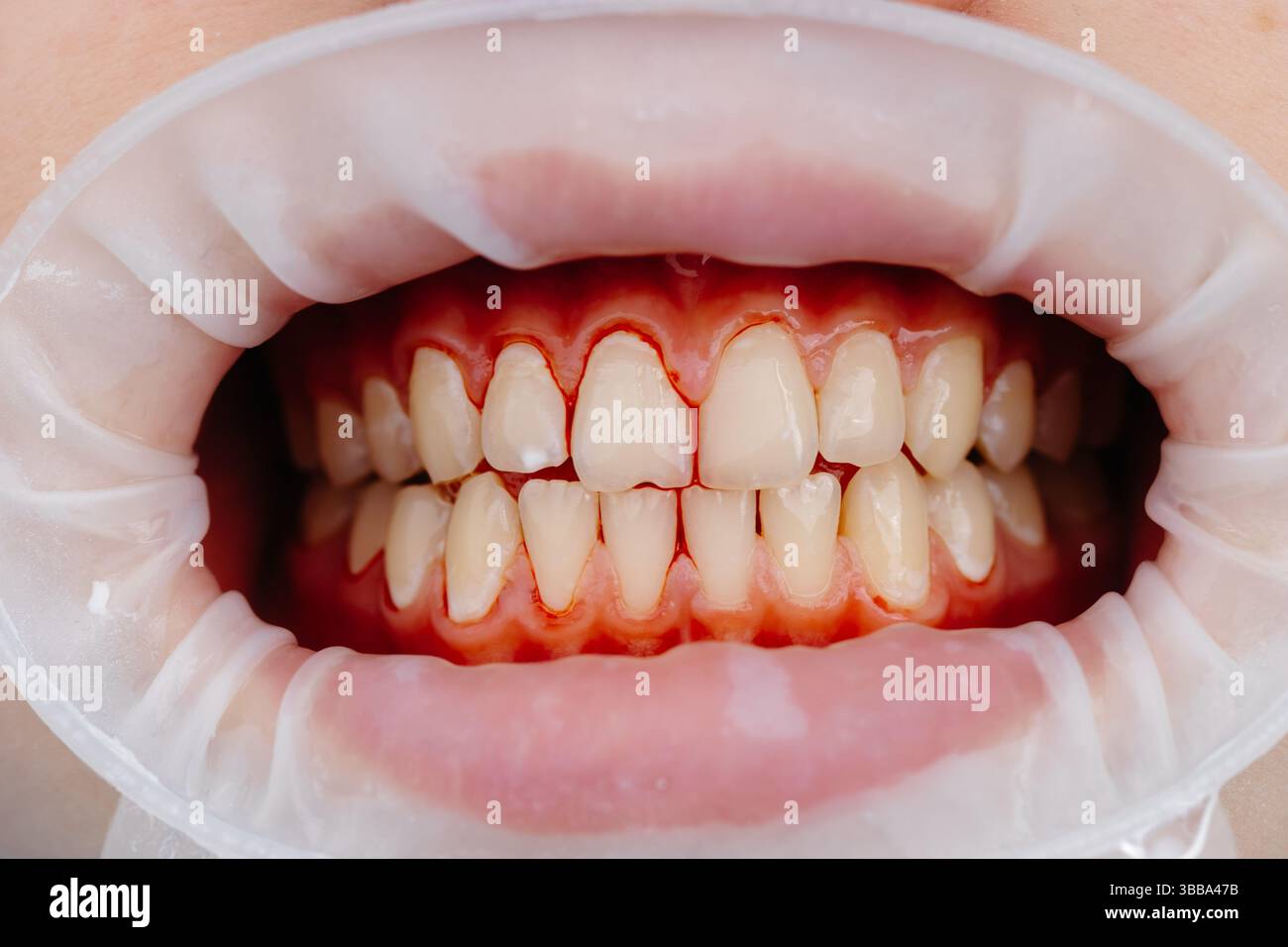 Primo piano dei denti del paziente durante l'esame odontoiatrico che mostra il divaricatore della guancia e gengive sane Foto Stock