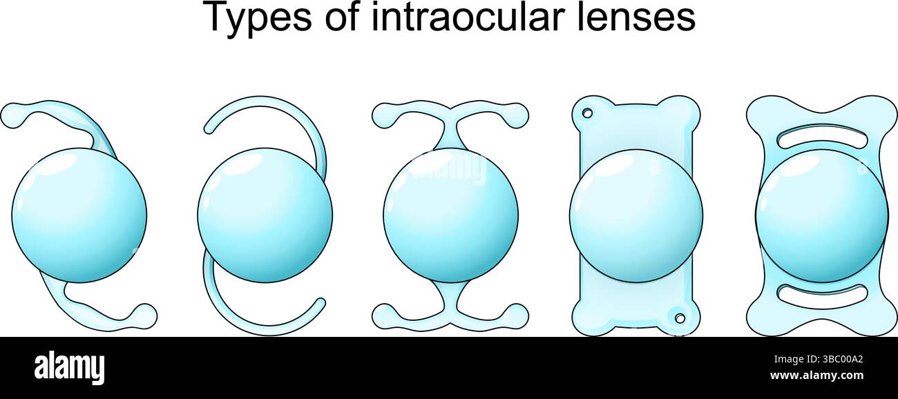 Tipi di lenti intraoculari in correzione della vista. Chirurgia cataratta. Illustrazione vettoriale. Poster medico. Diagramma schematico Illustrazione Vettoriale