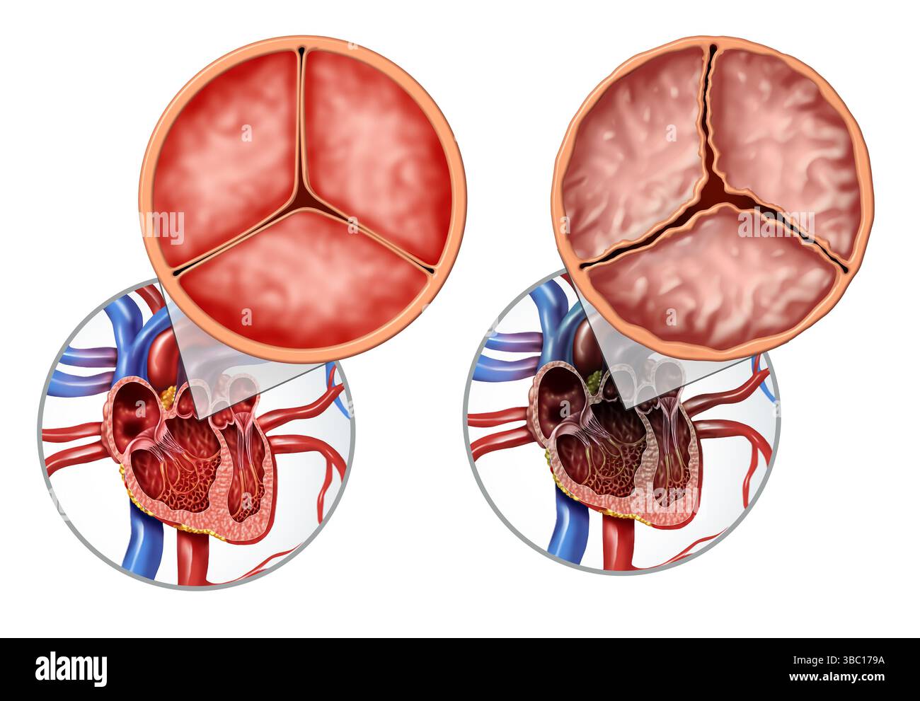 Disturbo della valvola aortica o valvulopatia come diagramma anatomico della malattia cardiaca umana e concetto di illustrazione medica Foto Stock