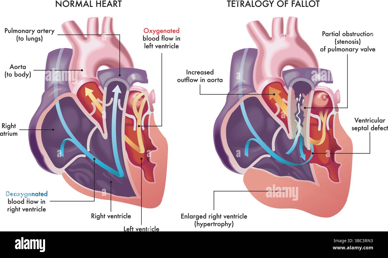 Illustrazione che mostra un cuore normale e uno con sintomi di Tetralogia di Fallot, una malattia cardiovascolare, con annotazioni. Illustrazione Vettoriale