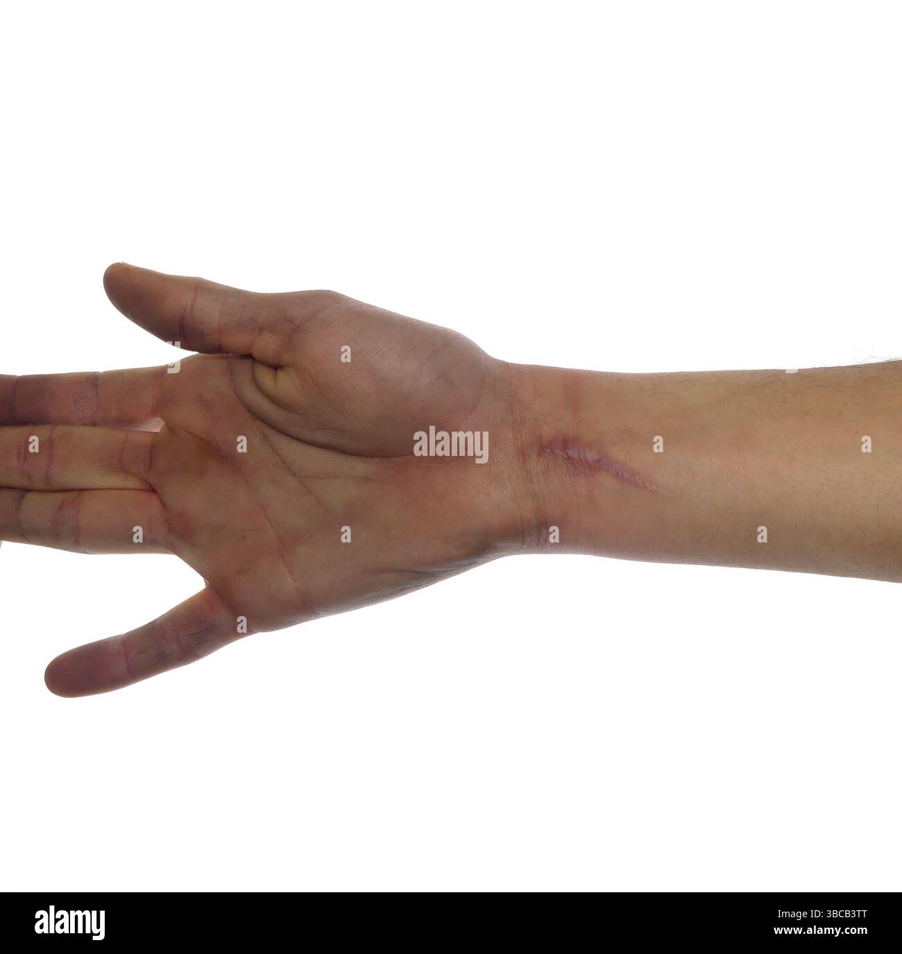 Auto-danno Scar sul polso - contesto emotivo e medico Foto Stock