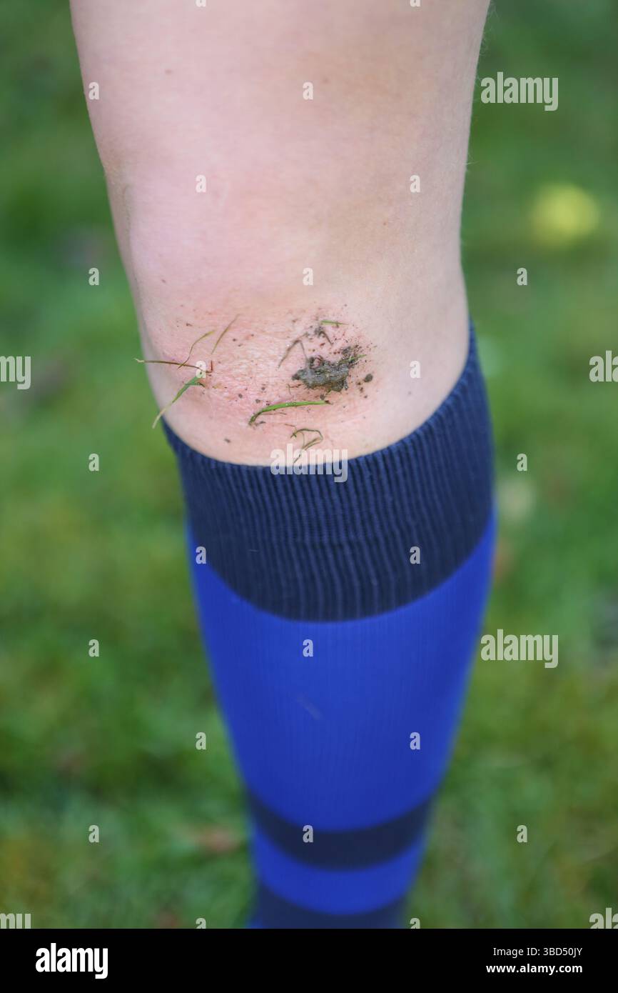 Ragazza calciatrice ginocchio fangoso con fango sopra le calze da calcio blu Foto Stock
