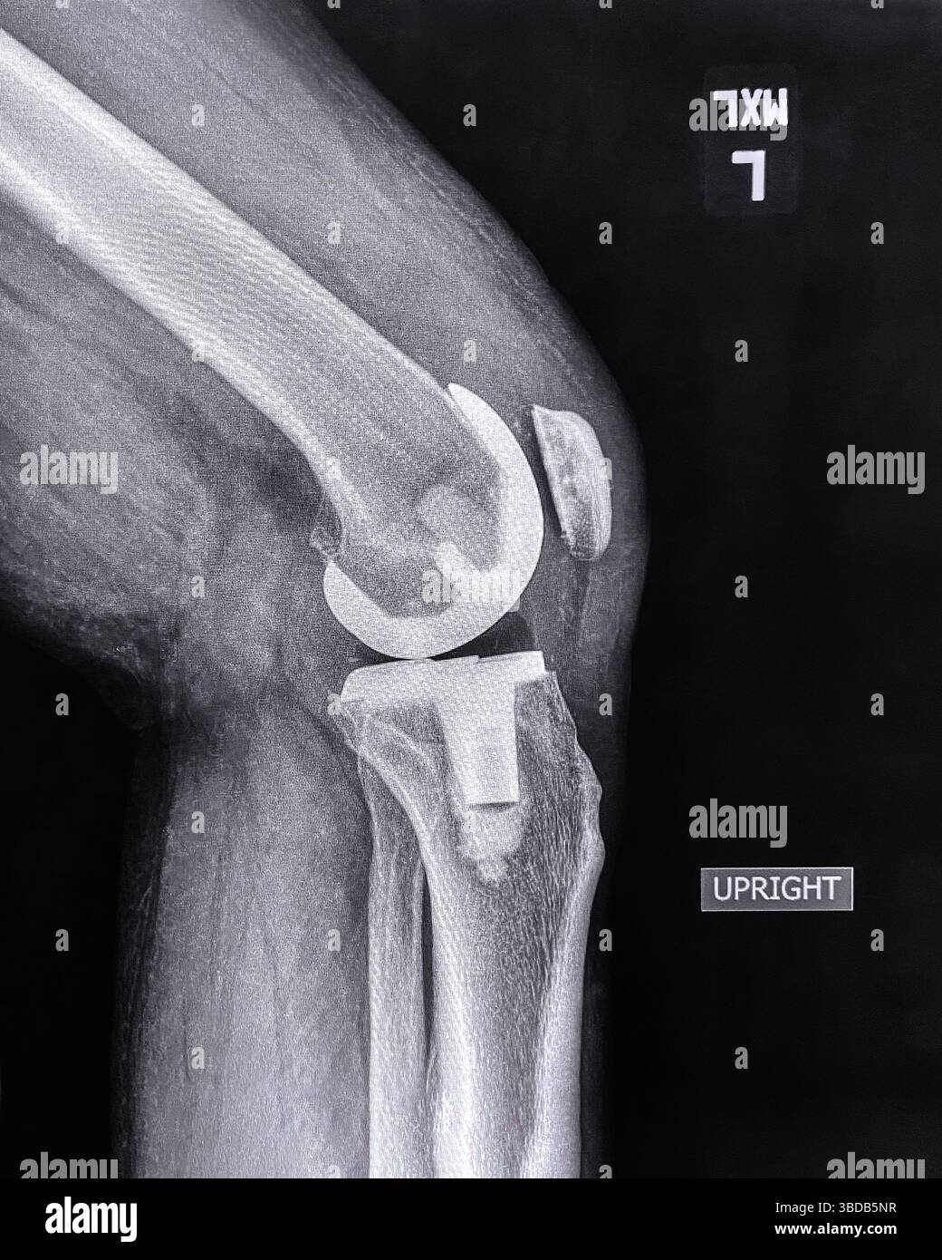 Radiografia del ginocchio di un uomo adulto dopo un intervento di sostituzione del ginocchio Foto Stock