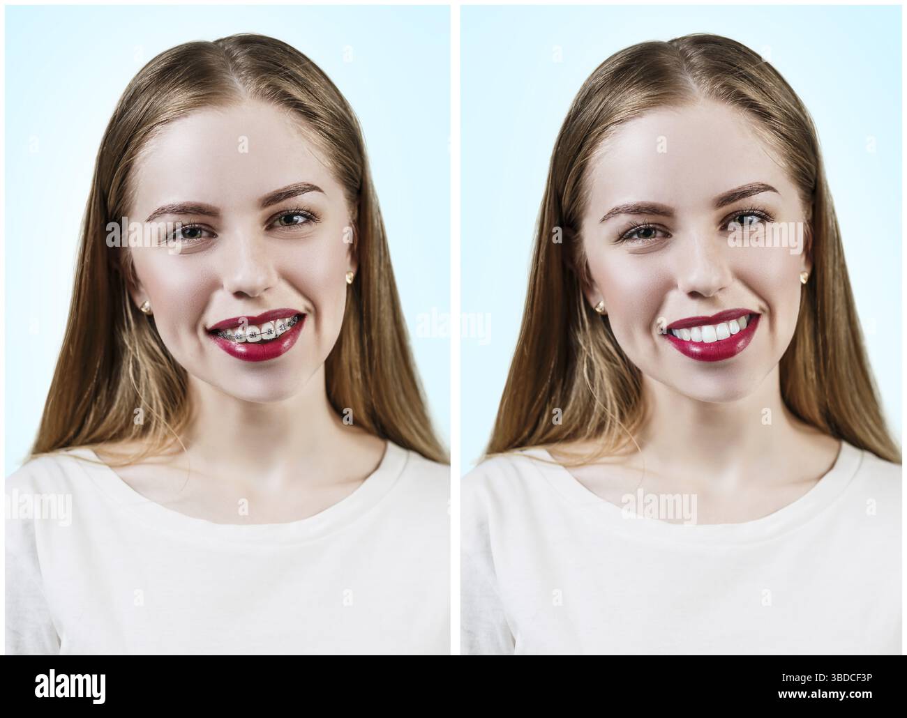 Giovane donna con denti perfetti prima e dopo la parentesi graffe su sfondo blu Foto Stock