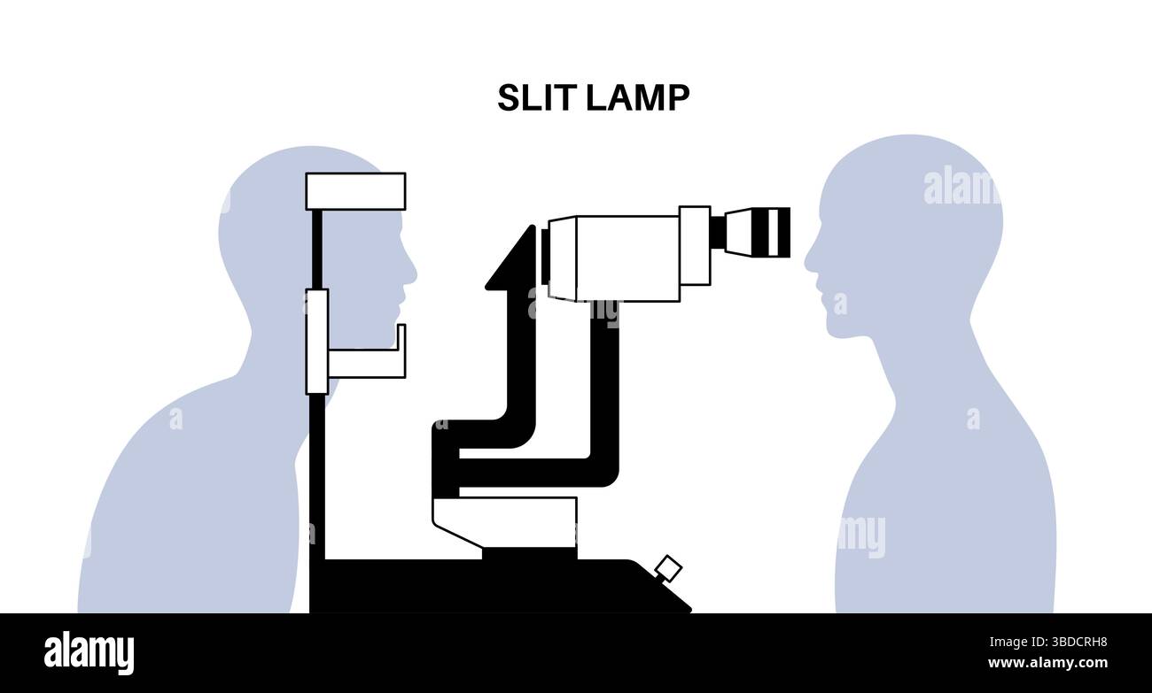 Immagine di un esame con lampada a fessura. Si tratta di una procedura di routine che utilizza un microscopio specializzato con una sorgente luminosa brillante per esaminare le strutture interne ed esterne dell'occhio. È spesso usato per monitorare varie condizioni oculari, tra cui cataratta e glaucoma. Foto Stock