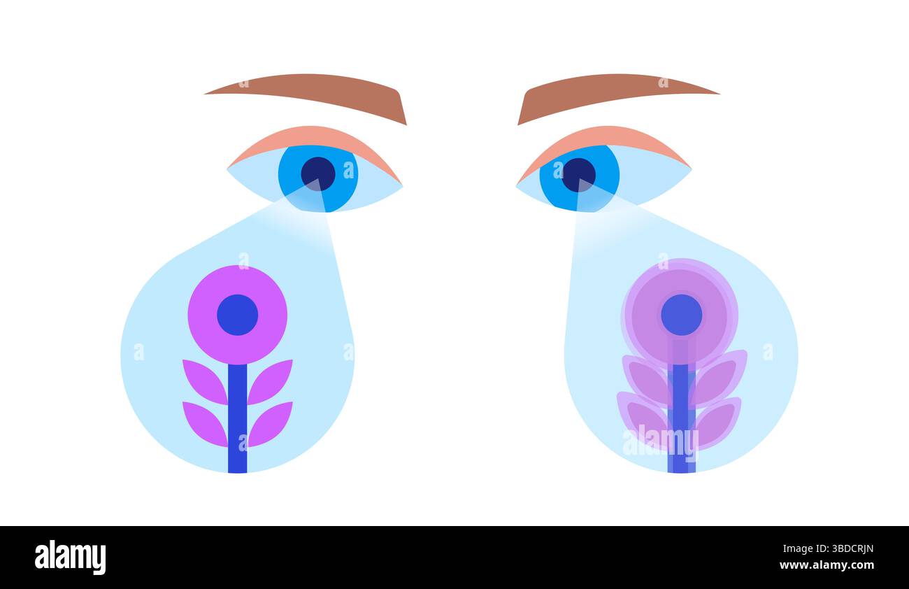 Illustrazione di ambliopia, chiamata anche occhio pigro. Si tratta di una riduzione della vista in un occhio causata da uno sviluppo visivo anomalo nelle prime fasi della vita. Gli occhi più deboli o pigri spesso vagano verso l'interno o verso l'esterno. I trattamenti includono lenti correttive, interventi chirurgici per allineare gli occhi disallineati e terapia della vista. Foto Stock