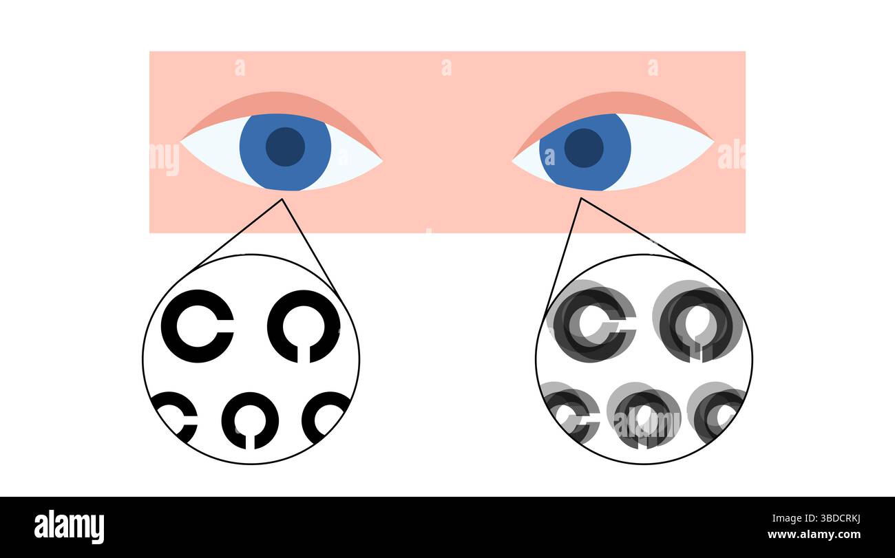 Illustrazione di ambliopia, chiamata anche occhio pigro. Si tratta di una riduzione della vista in un occhio causata da uno sviluppo visivo anomalo nelle prime fasi della vita. Gli occhi più deboli o pigri spesso vagano verso l'interno o verso l'esterno. I trattamenti includono lenti correttive, interventi chirurgici per allineare gli occhi disallineati e terapia della vista. Foto Stock