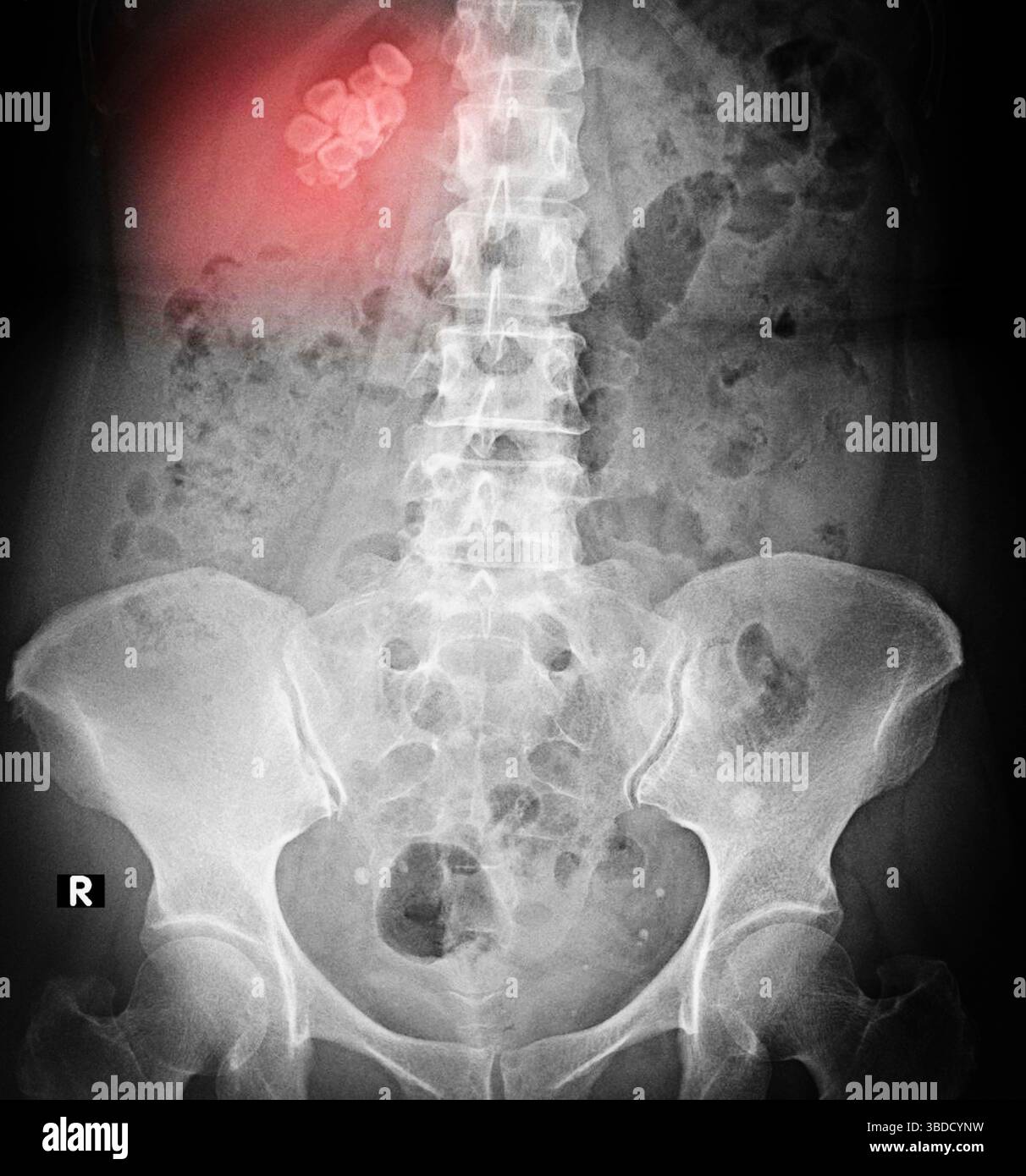 Radiografia colorata dei calcoli biliari (rossa) nella parte superiore dell'addome del paziente. I calcoli biliari sono corpi formati dall'indurimento dei depositi di colesterolo e sali biliari. Le pietre portano ad attacchi di dolore estremo nell'addome dopo pasti grassi. Il trattamento può essere non invasivo (suddiviso in base a farmaci o ultrasuoni) o invasivo (rimozione chirurgica). Foto Stock