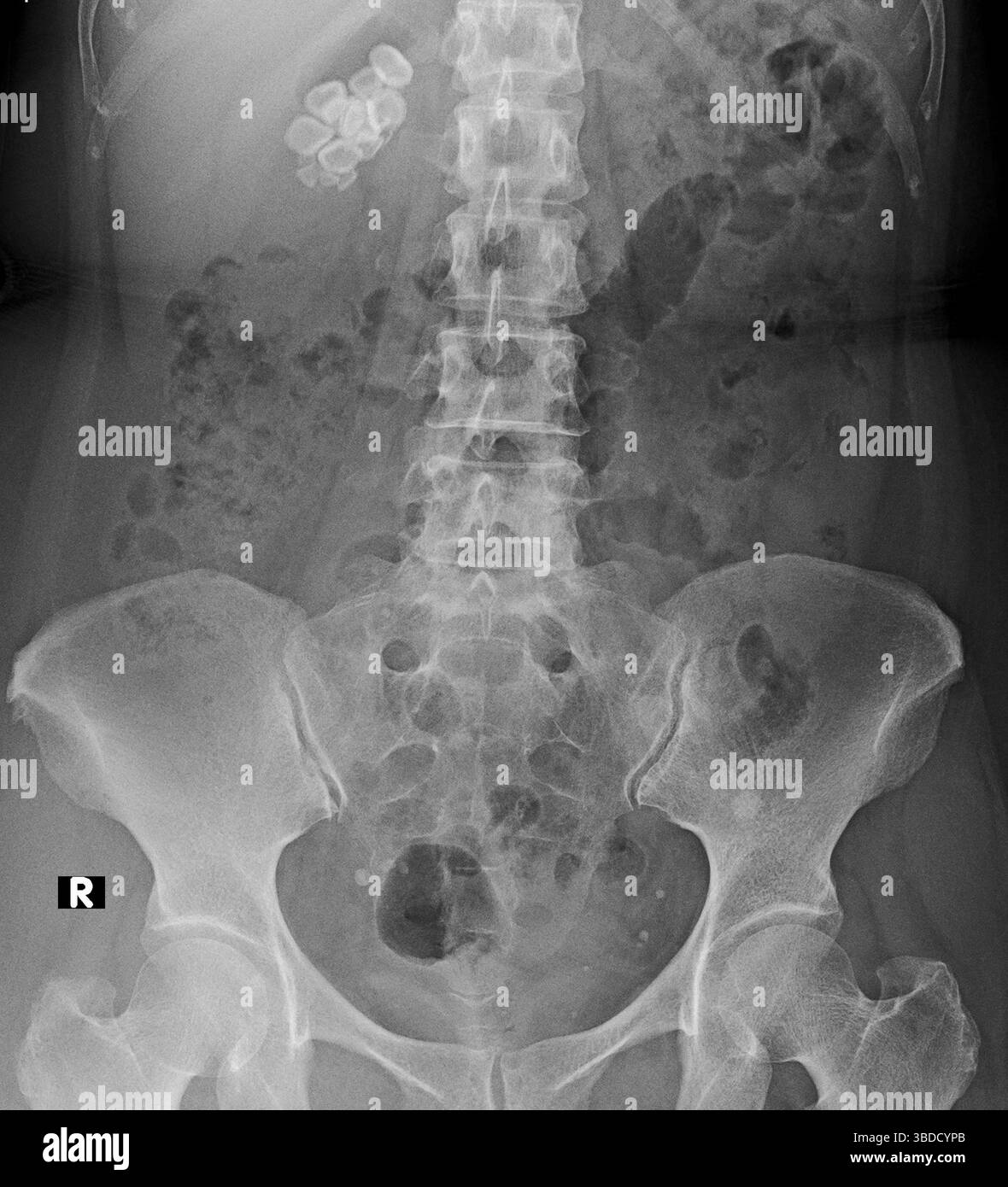 Radiografia dei calcoli biliari (bianca, in alto al centro a sinistra) nella parte superiore dell'addome del paziente. I calcoli biliari sono corpi formati dall'indurimento dei depositi di colesterolo e sali biliari. Le pietre portano ad attacchi di dolore estremo nell'addome dopo pasti grassi. Il trattamento può essere non invasivo (suddiviso in base a farmaci o ultrasuoni) o invasivo (rimozione chirurgica). Foto Stock