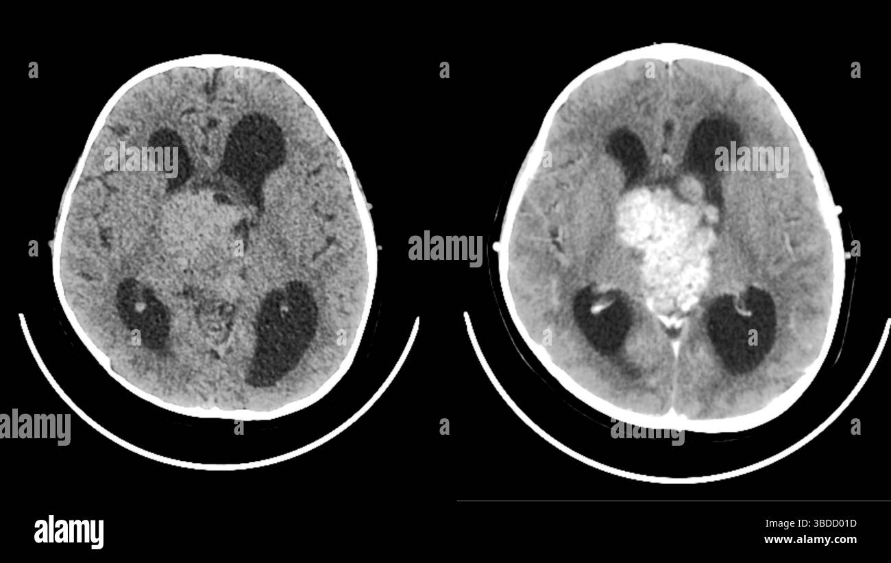 Tomografia computerizzata (TC) del cervello di un paziente che mostra un ependimoma (bianco). Gli Ependymomas sono rari tumori maligni (cancerosi) del sistema nervoso centrale (cervello e midollo spinale). Essi derivano dalle cellule che rivestono le cavità (ventricoli) del cervello. Foto Stock