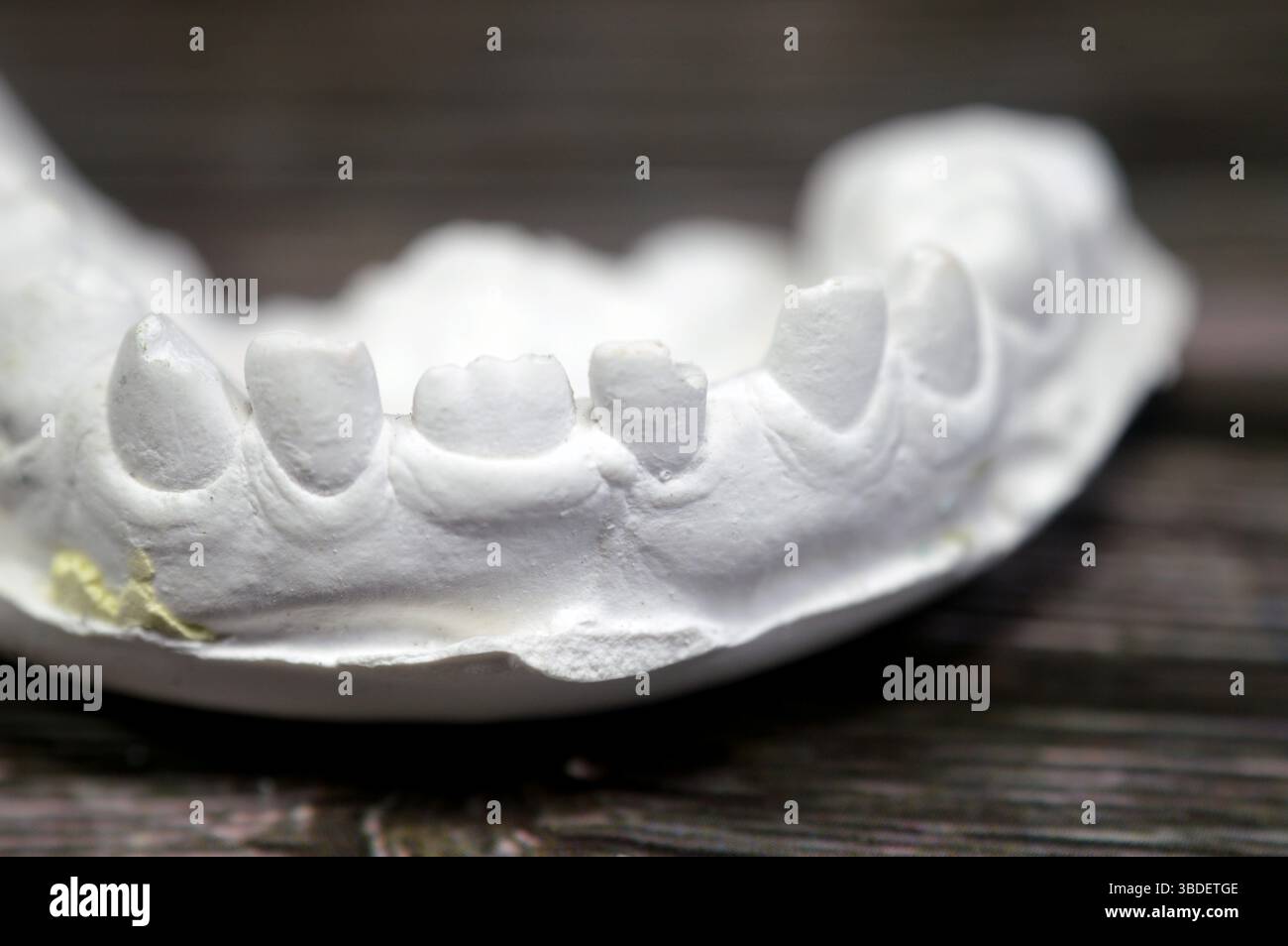 Il modello di fusione dentale ottenuto da impronta (un'impronta negativa dei denti e dei tessuti molli), modello di studio, è una riproduzione positiva della tettarella di un paziente Foto Stock