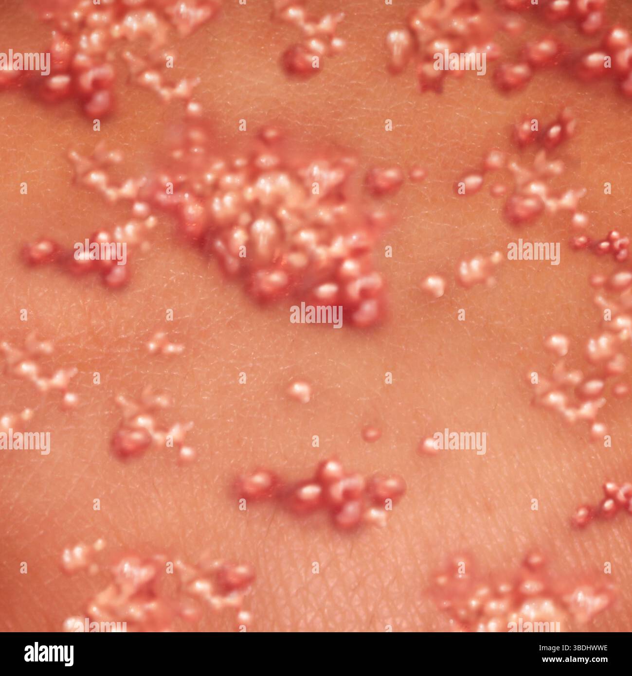 Herpes virus e herpes zoster come un'eruzione cutanea contagiosa con vesciche come piaghe fredde o malattia di focolaio di varicella come un concetto di illustrazione medica. Foto Stock