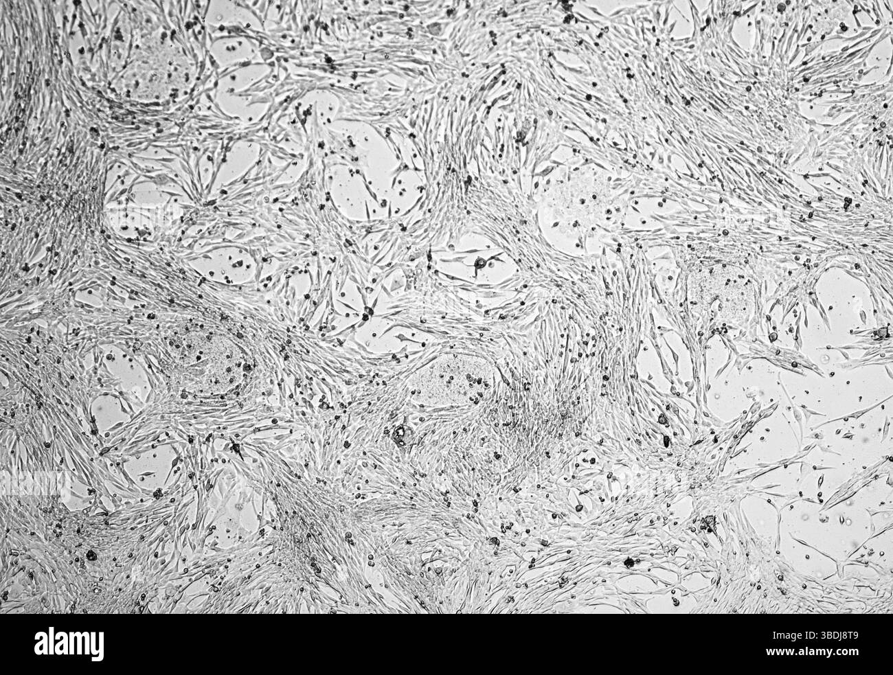 Coltura cellulare glioblastoma. Cellule di astrocitoma maligno umano sotto un microscopio. Foto Stock