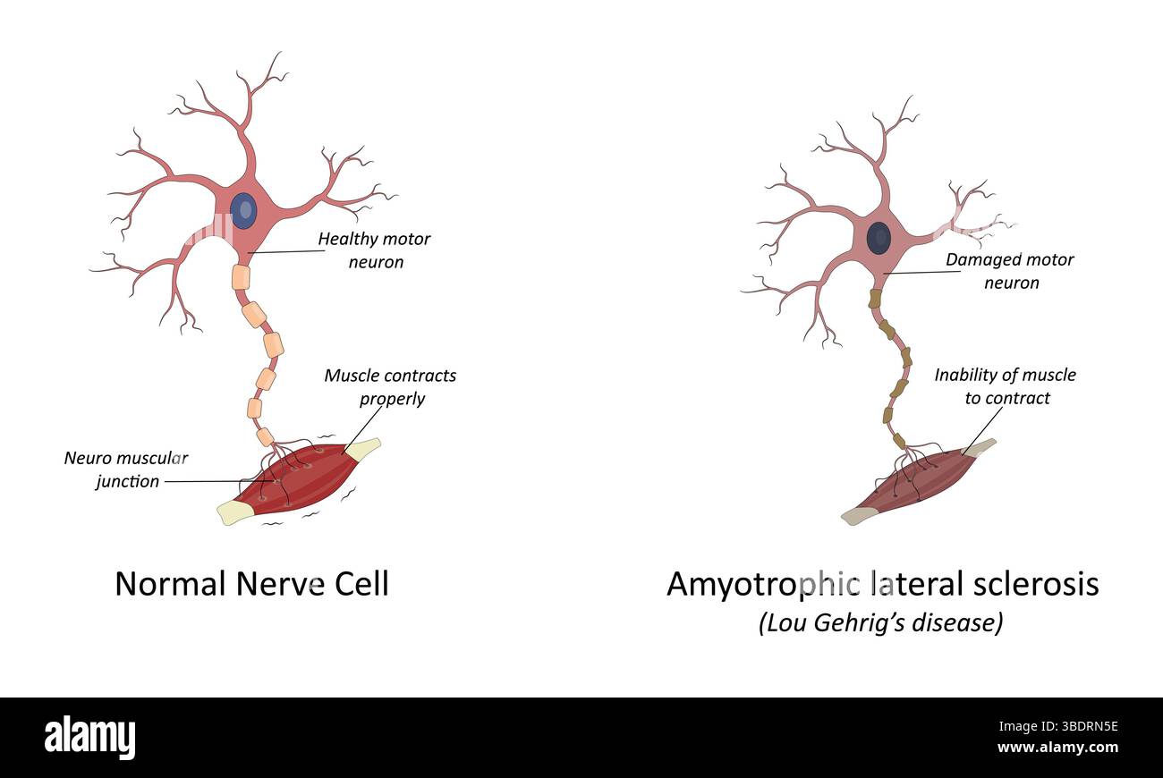 Illustrazione vettoriale della sclerosi laterale amiotrofica (ALS) Illustrazione Vettoriale