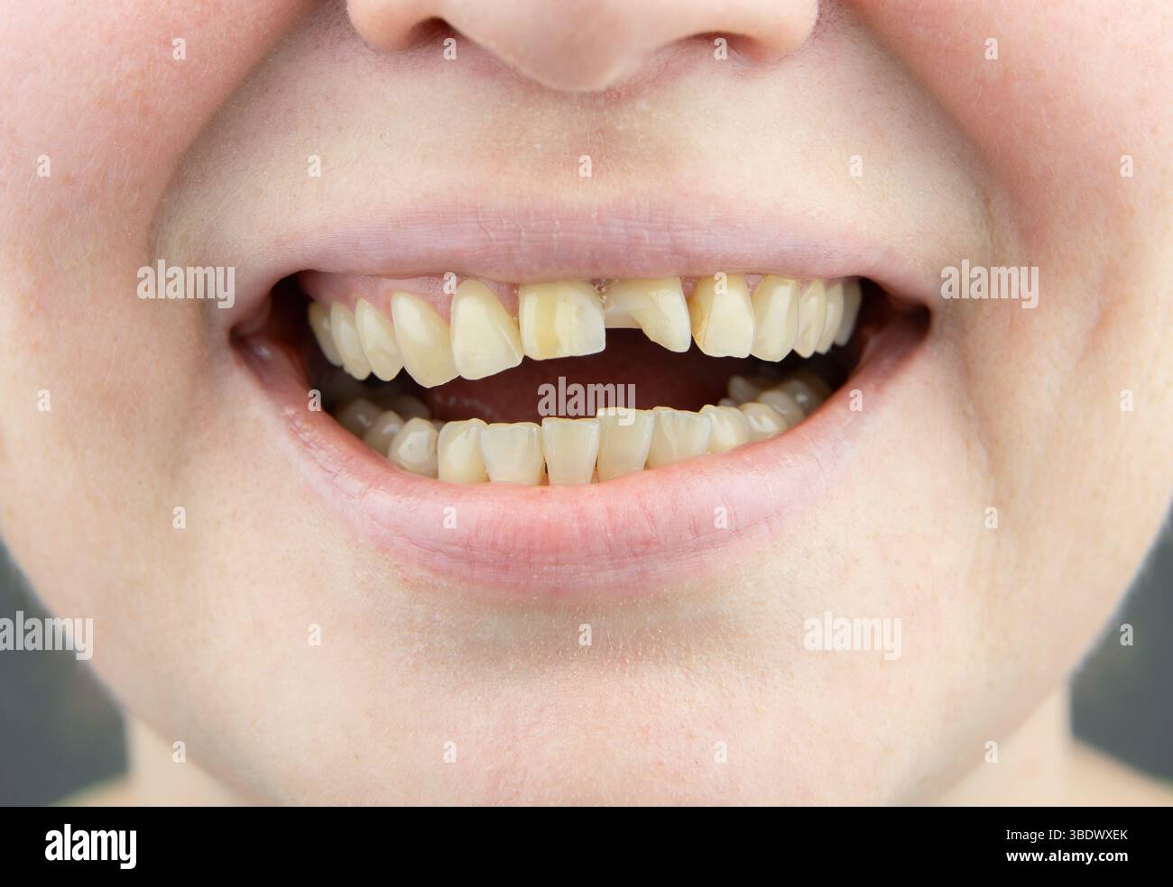 Vista ravvicinata della bocca di una donna adulta con dente anteriore rotto. Un dente anteriore rotto deve essere riparato. Concetto di cura dentale dei denti. Foto Stock