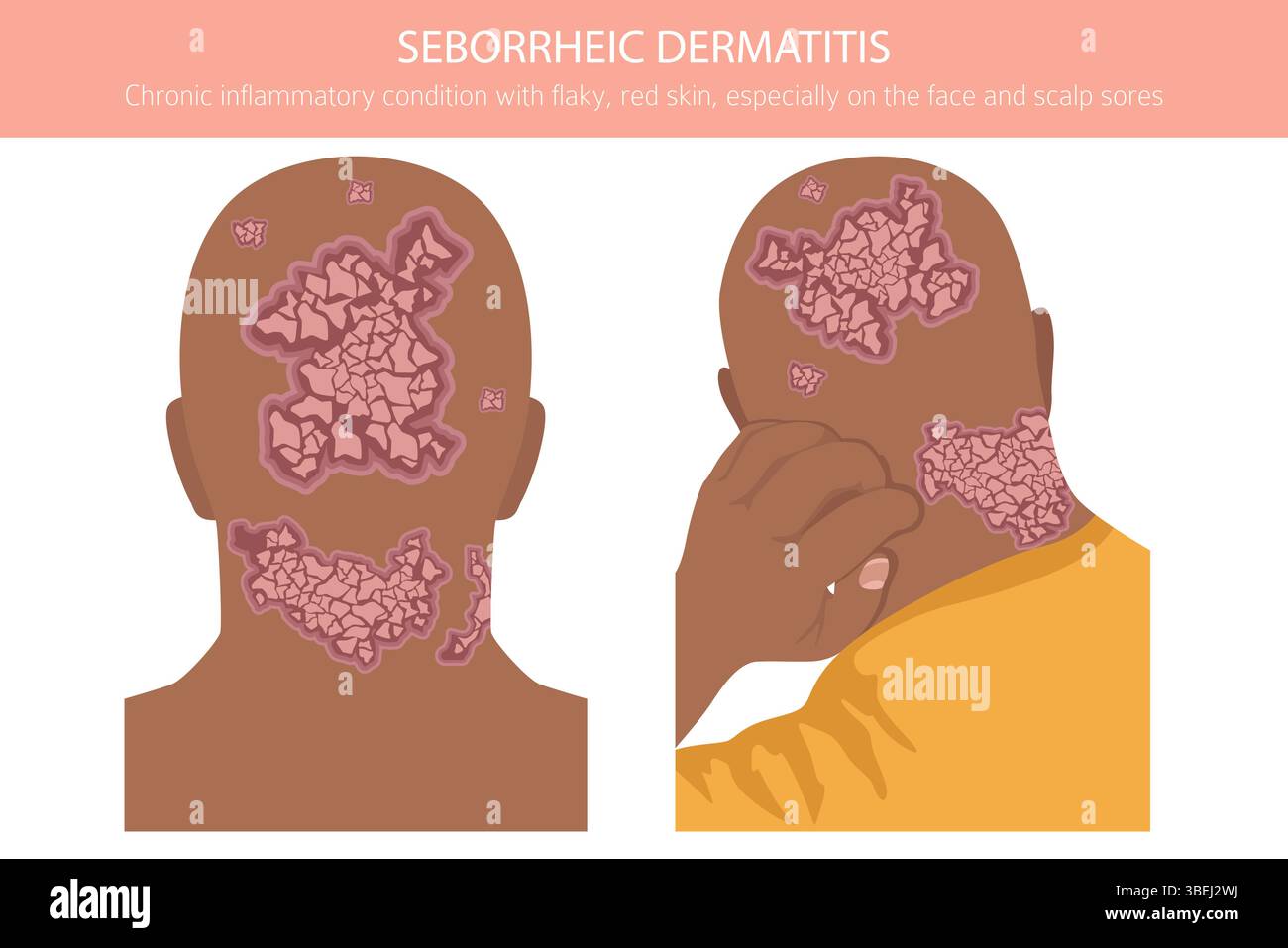 Dermatite seborroica. Malattie della pelle. Progettazione infografica medica. Illustrazione vettoriale Illustrazione Vettoriale