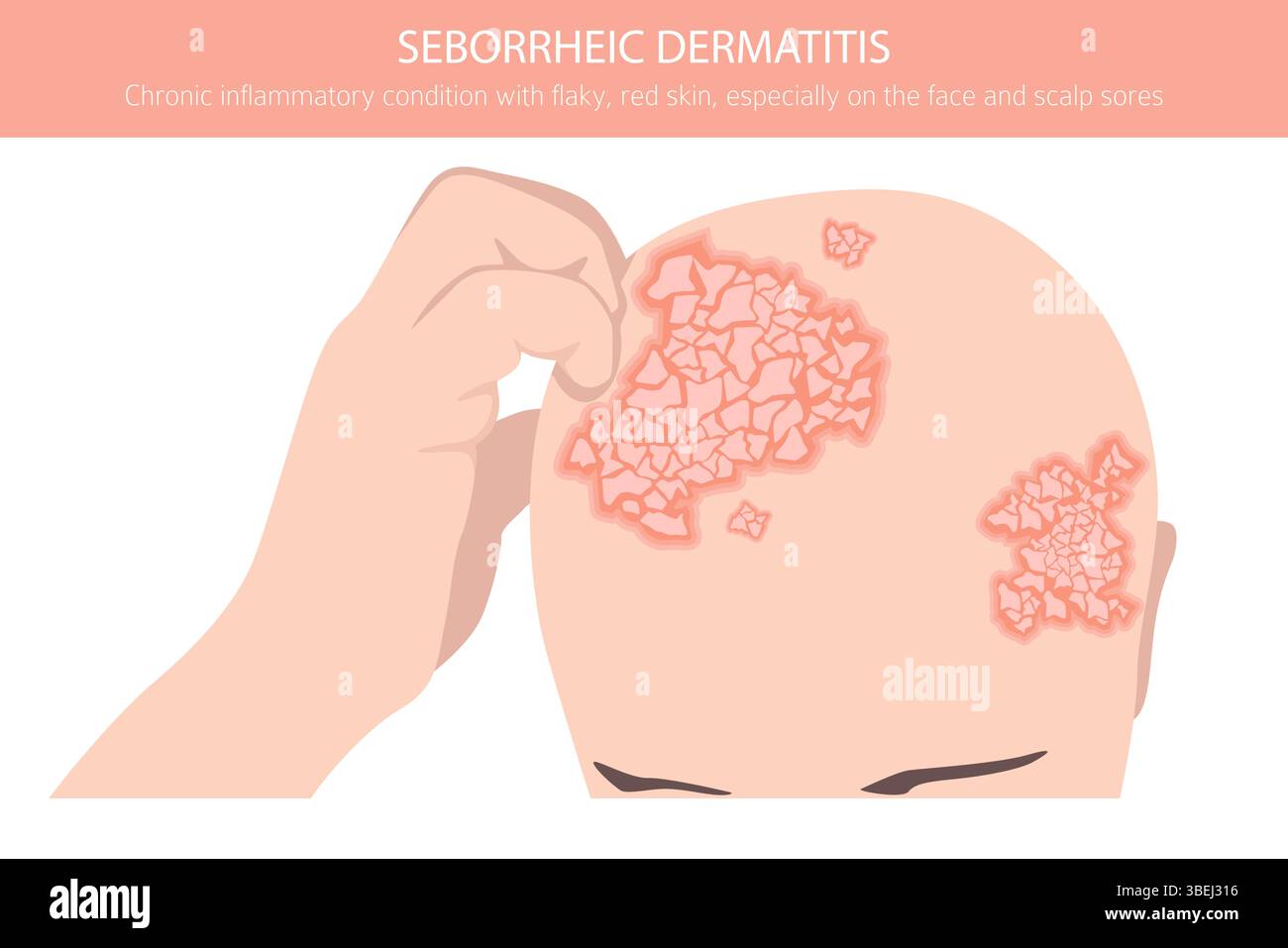 Dermatite seborroica. Malattie della pelle. Progettazione infografica medica. Illustrazione vettoriale Illustrazione Vettoriale