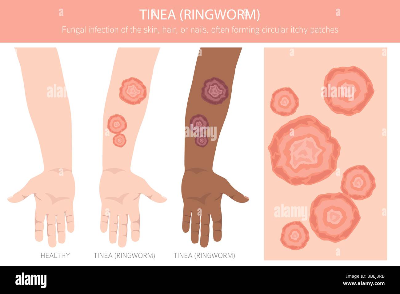 Tinea. Tigna. Malattie della pelle. Progettazione infografica medica. Illustrazione vettoriale Illustrazione Vettoriale