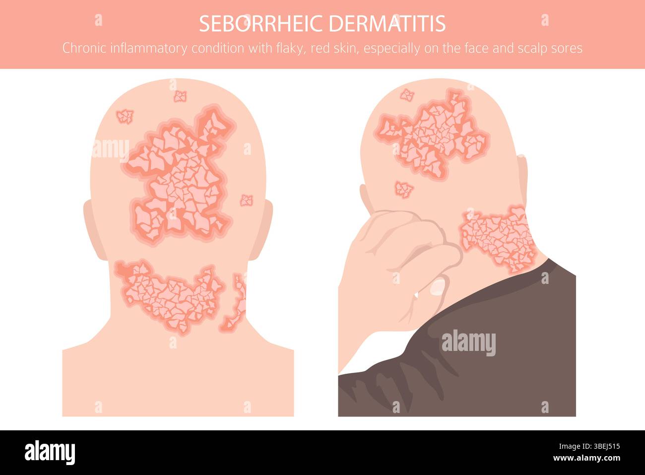 Dermatite seborroica. Malattie della pelle. Progettazione infografica medica. Illustrazione vettoriale Illustrazione Vettoriale