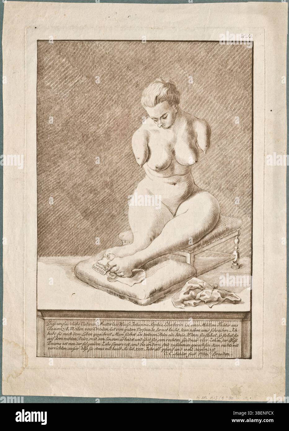 Un disegno anatomico di otto Christian Saler raffigurante Johanna Sophia Libscherin, nata senza braccia e ginocchia, con gambe disuguali. L'opera fa parte della collezione BPL 1913 i 9 ed è stata creata nel 1769. Foto Stock