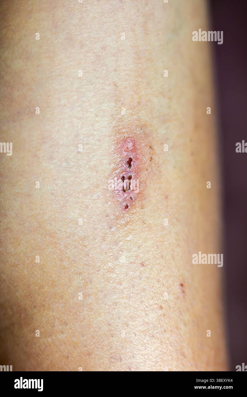 Una vista dettagliata di una lesione cutanea situata sulla superficie del braccio, che somiglia molto a un blister Foto Stock