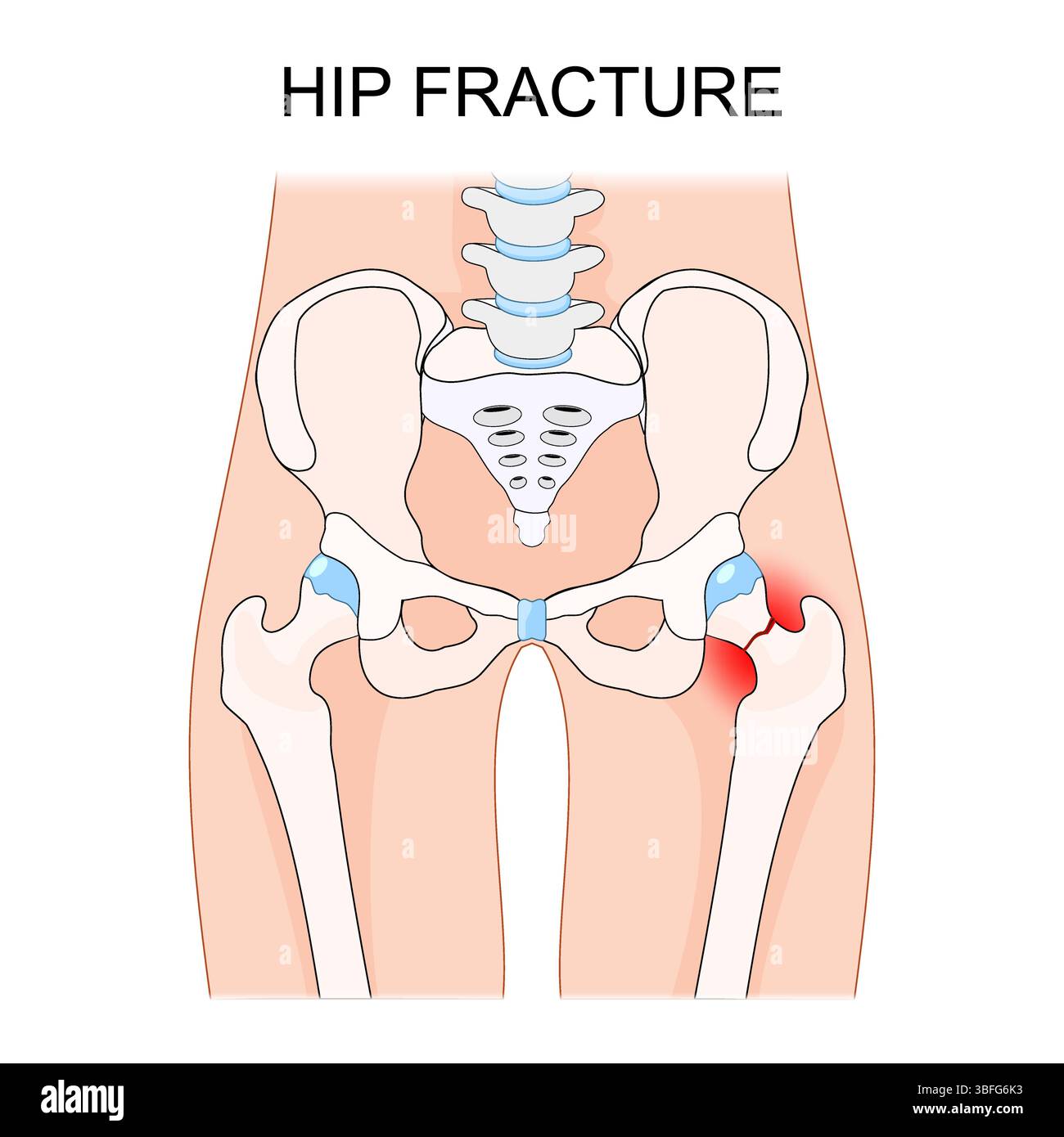 Frattura dell'anca. Frattura prossimale del femore. frattura esposta del collo femorale. Illustrazione Vettoriale
