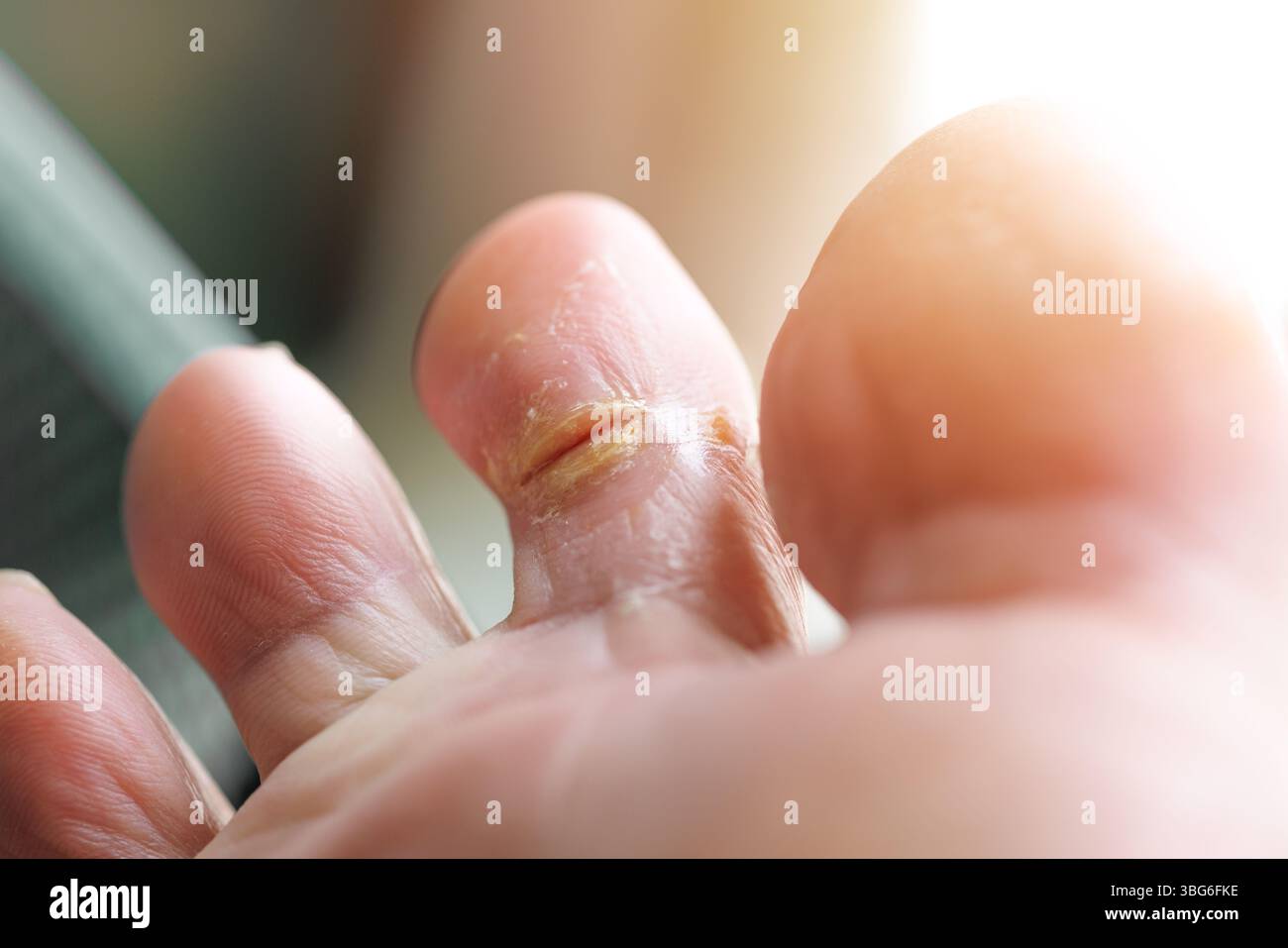 Secche, ferite all'alluce incrinate infezione piedi umidi bagnati funghi della pelle, piede atleta Tinea pedis Foto Stock
