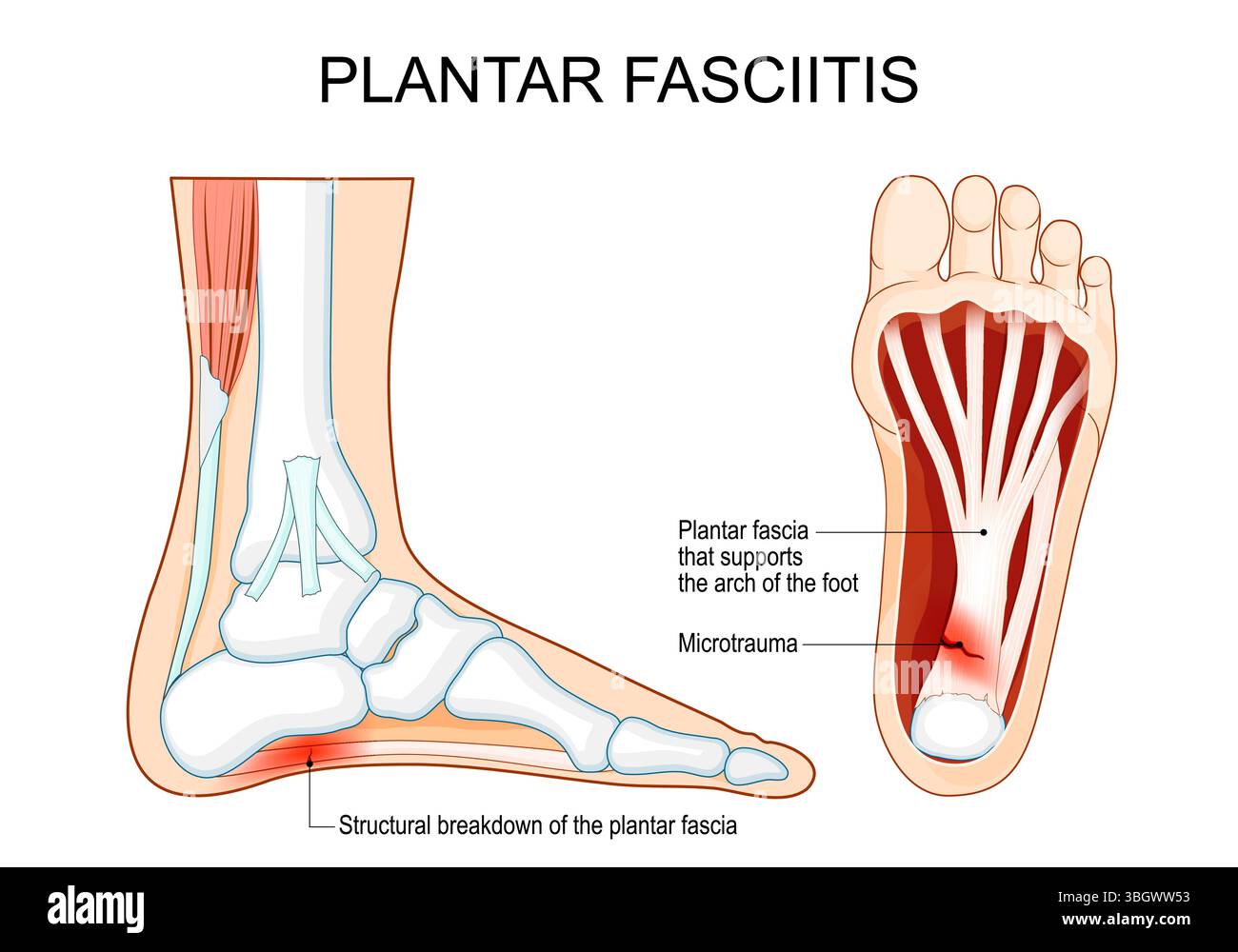 Fascite plantare. Dolore al tallone. Sezione trasversale della gamba umana. Rottura strutturale della fascia plantare. Microtrauma del tessuto connettivo spesso Illustrazione Vettoriale