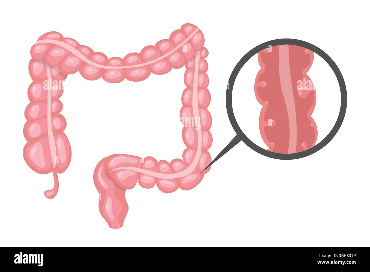 Polipi che si sviluppano all'interno dell'intestino crasso, portando a vari problemi intestinali, raffigurati in un'illustrazione anatomica con una vista ingrandita Illustrazione Vettoriale