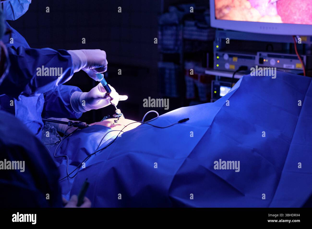 LK Osnabrück, Deutschland 30. Januar 2023: IM Bild: Ein kritischer Moment während einer Gallenblasenoperation in einem hochmodernen Operationssaal eines Krankenhauses. Ein medizinisches Fachpersonal, Arzt, gekleidet in sterile OP-Kleidung und mit chirurgischen Handschuhen, ist dabei, Gallenflüssigkeit mit Hilfe einer Spritze und spezieller Instrumente abzuziehen. Diese Instrumente werden durch kleine Zugänge, typisch für einen minimalinvasiven Eingriff z.B. Laparoskopie, in die Bauchdecke eingeführt. Die Präzision dieses Vorgangs ist entscheidend für den Erfolg der Operation und die Patientens Foto Stock