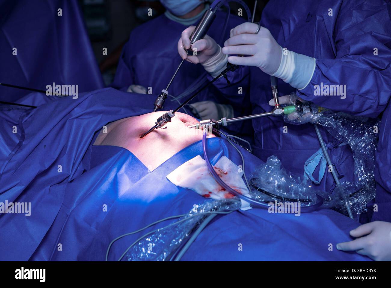 LK Osnabrück, Deutschland 30. Gennaio 2023: IM Bild: Minimalinvasiver Eingriff bei einer Gallenblasenoperation in einem hochmodernen Operationssaal eines Krankenhauses. Der Operateur, in steriler OP-Kleidung und mit chirurgischen Handschuhen, arbeitet konzentriert durch kleine, präzise Hautschnitte in der Bauchdecke des Patienten. Durch diese minimalen Zugänge werden eine Kameraoptik und spezielle chirurgische Instrumente eingeführt. Die Kamera liefert Live-Bilder des Operationsfeldes auf Monitore, während der Chirurg mit den feinen Instrumenten den Eingriff präzise durchführt. Die Szene verdeu Foto Stock