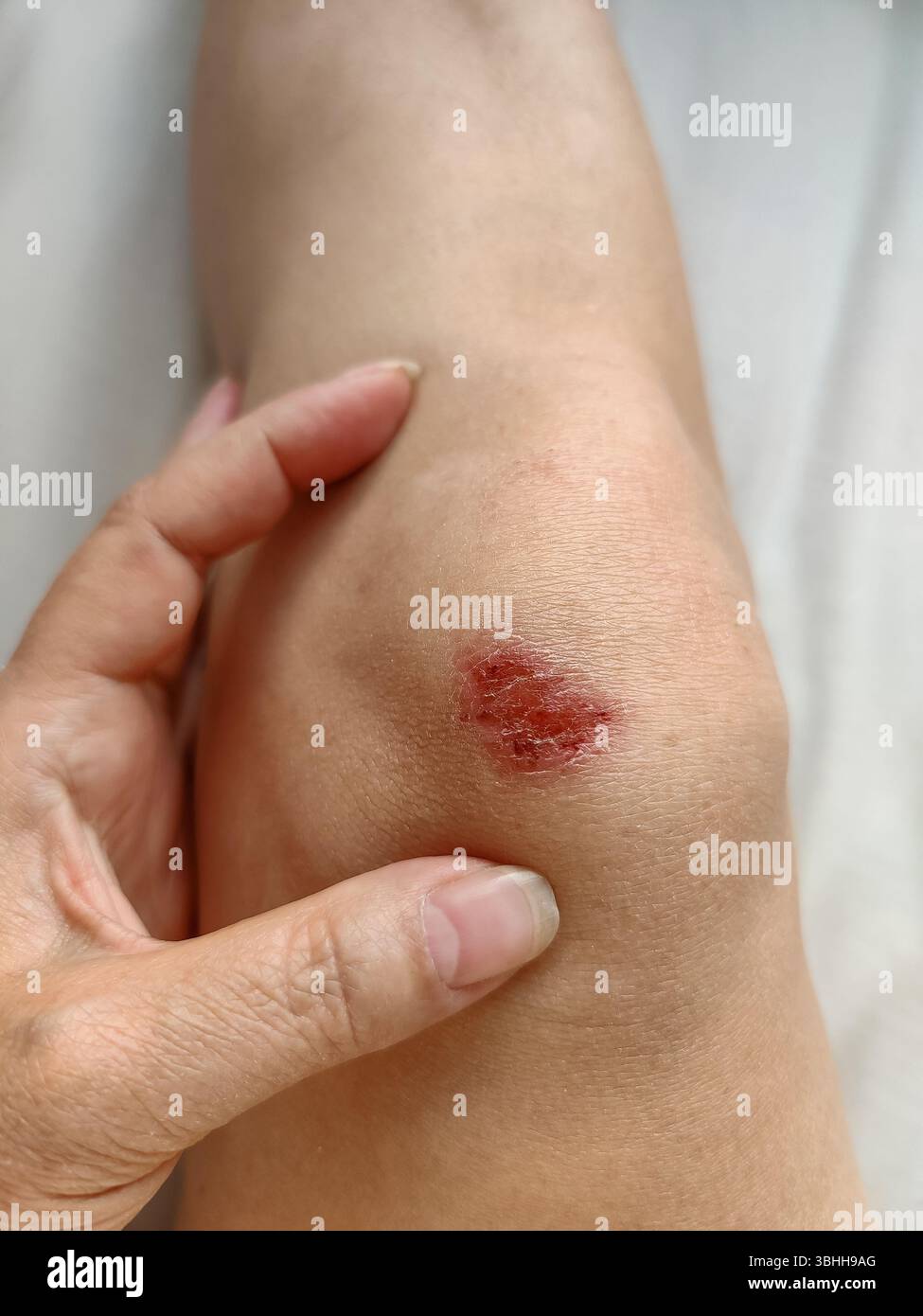 Ferita al ginocchio di una giovane donna snella. Guarigione della lesione cutanea dopo la caduta. Esame della superficie cutanea contro un foglio bianco. Vista dall'alto. Primo piano. Servizio fotocopie Foto Stock
