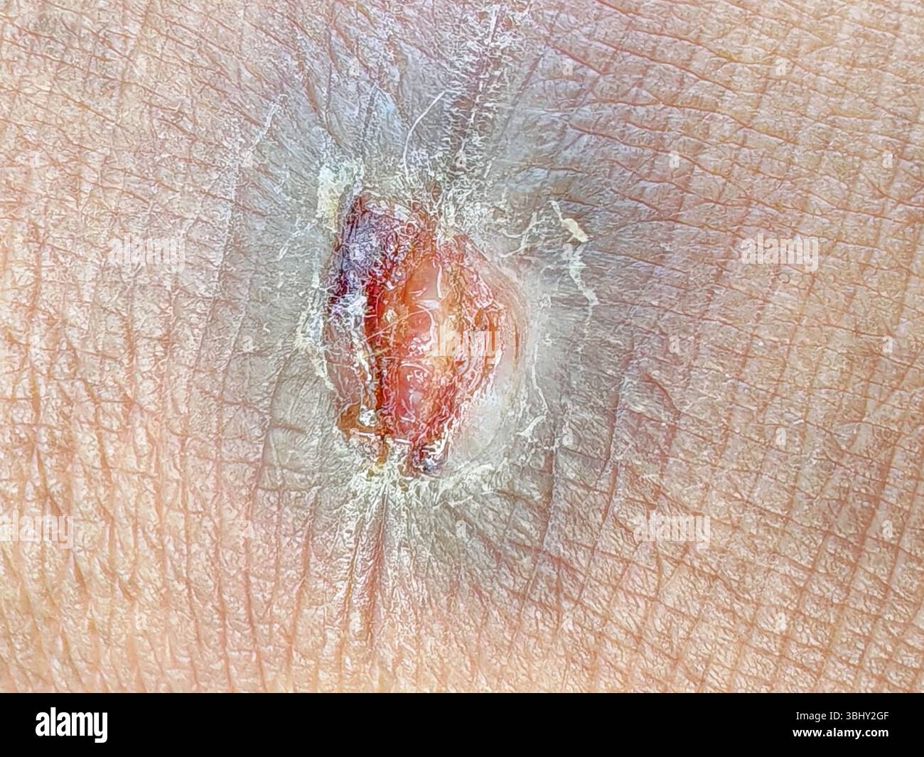 Primo piano della lesione cutanea con ferita e formazione Scab Foto Stock