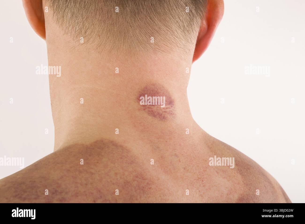 Coppettare i segni della terapia sulla schiena di un bell'uomo. Concetto di massaggio e benessere Foto Stock