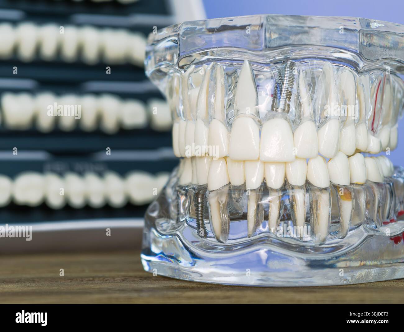 Modello di impianto dentale con set di denti sullo sfondo Foto Stock