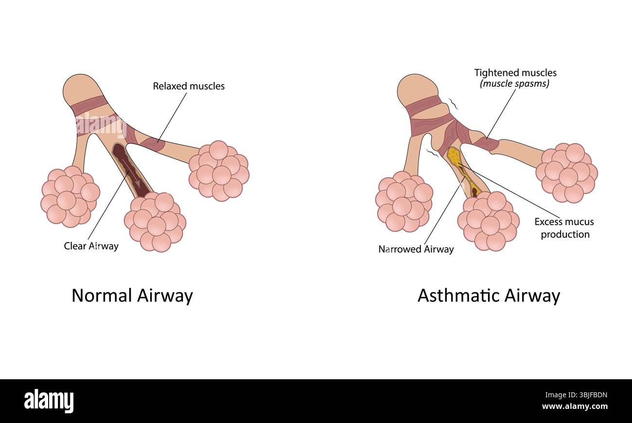Illustrazione del vettore dell'asma Illustrazione Vettoriale
