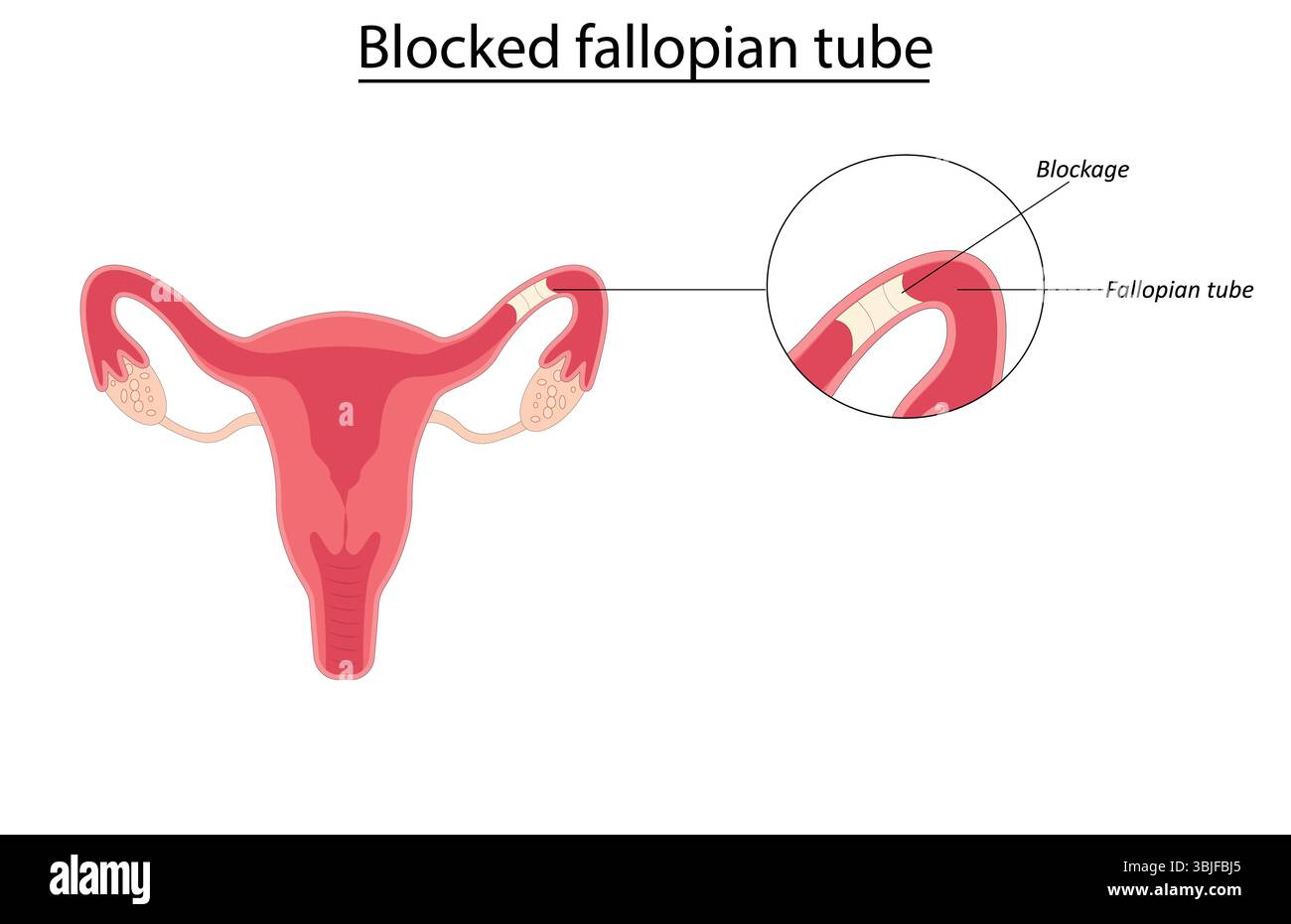 Illustrazione del vettore della tuba di Falloppio bloccata Illustrazione Vettoriale