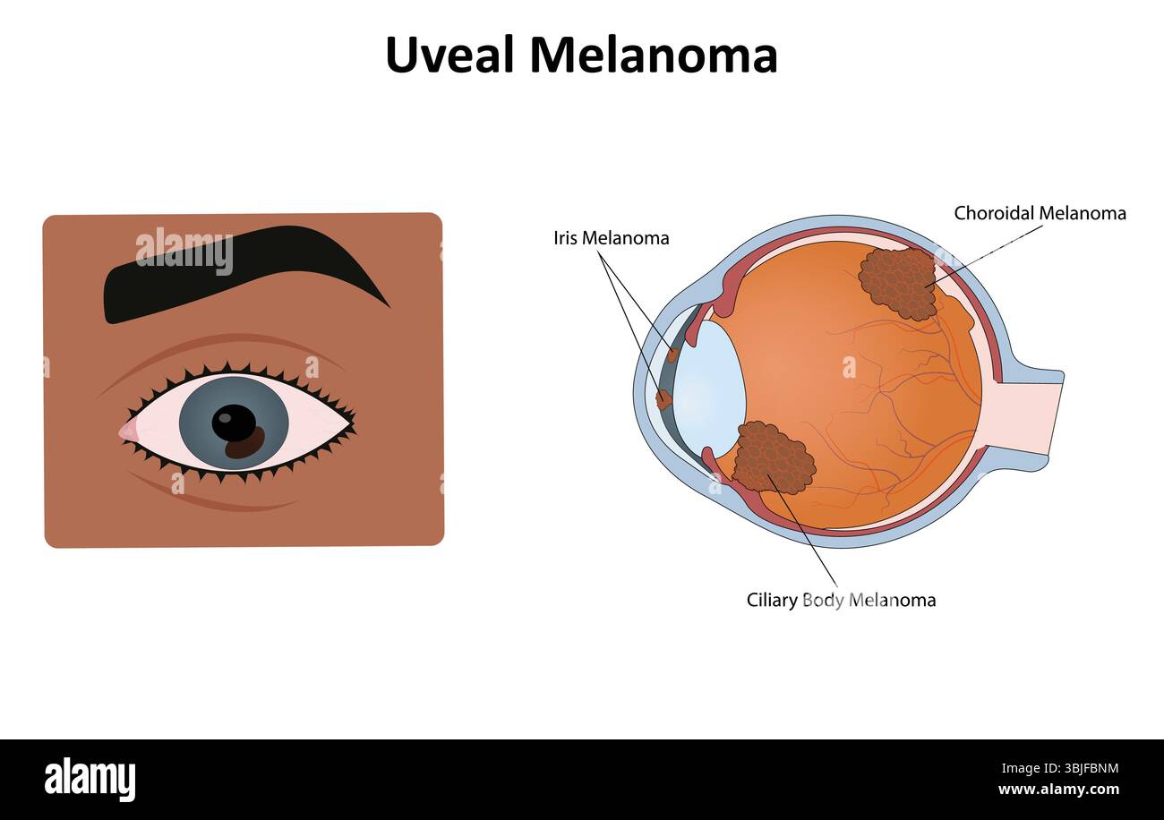 Illustrazione vettoriale del melanoma uveale Illustrazione Vettoriale
