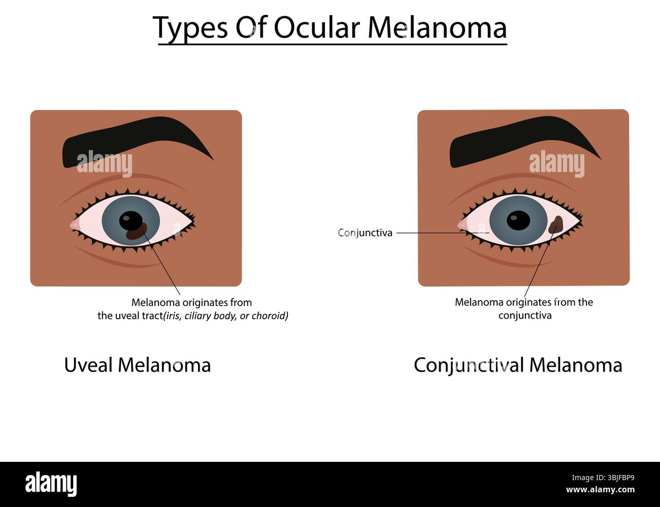 Tipi di illustrazione vettoriale del melanoma oculare Illustrazione Vettoriale