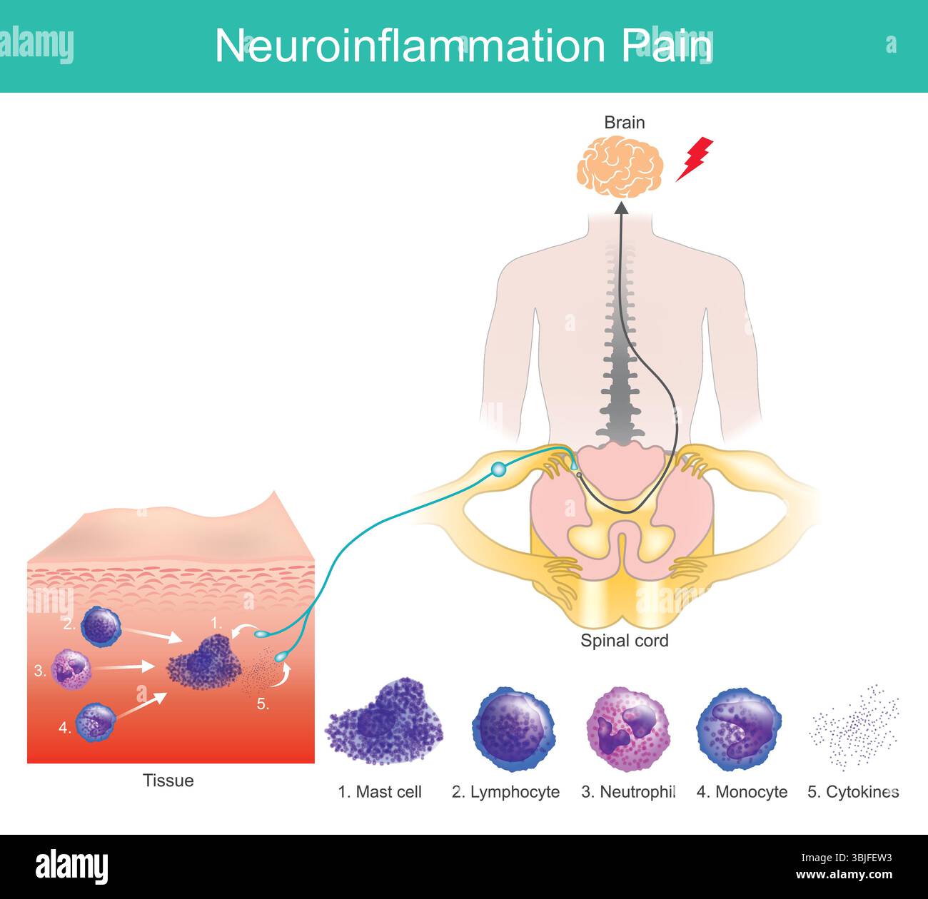 Neuroinfiammazione e diagramma delle vie del dolore. Il processo di neuroinfiammazione ha un ruolo importante nell'emicrania. Illustrazione Vettoriale