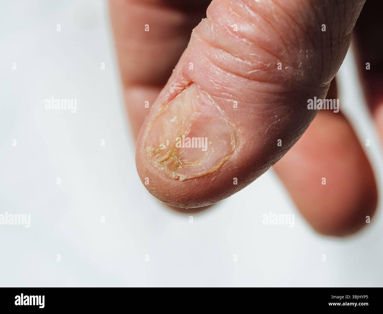 La piastra del pollice sulla mano è incrinata e danneggiata Foto Stock