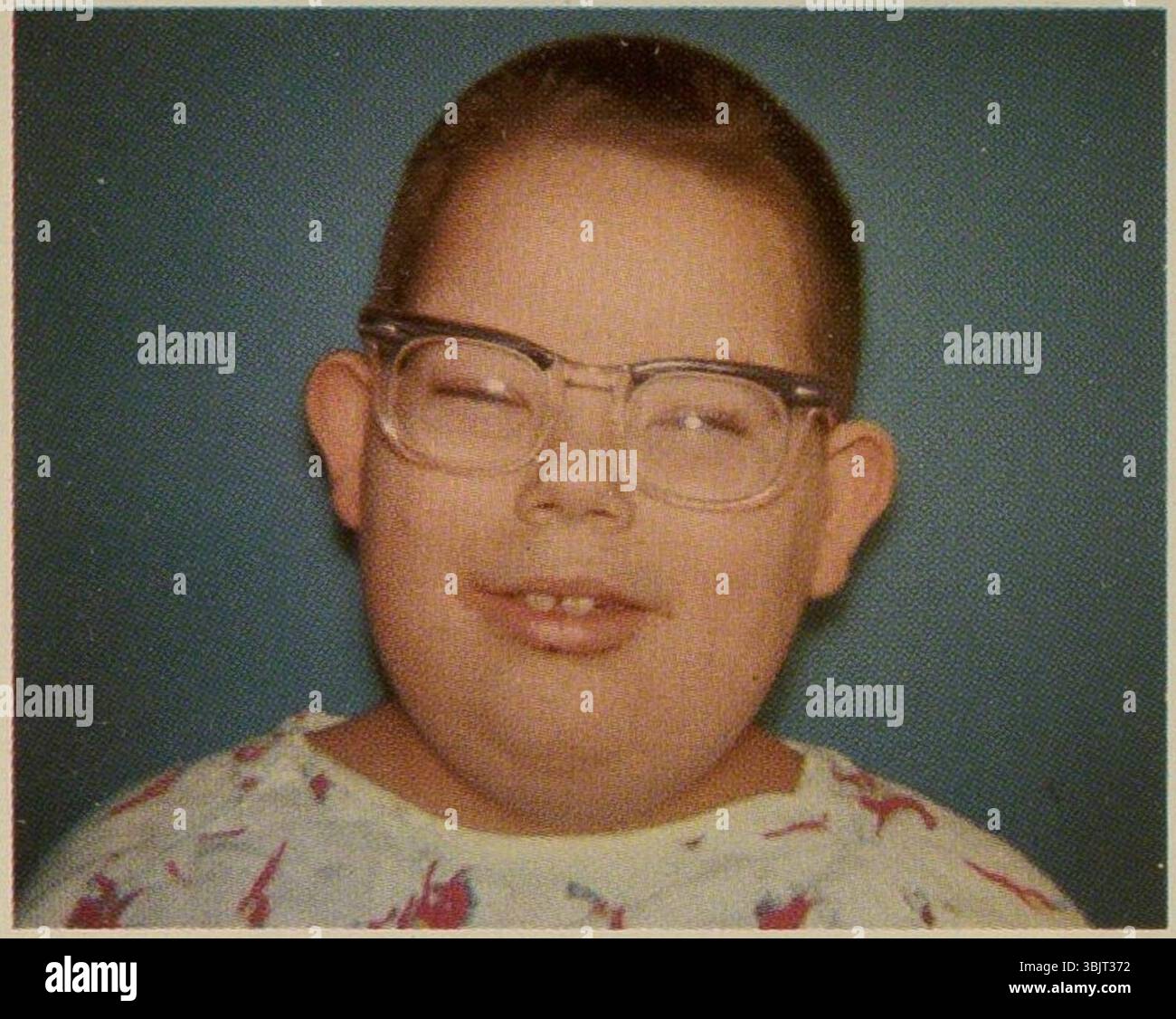 Sindrome di Laurence-Moon-Biedl 1. Foto Stock