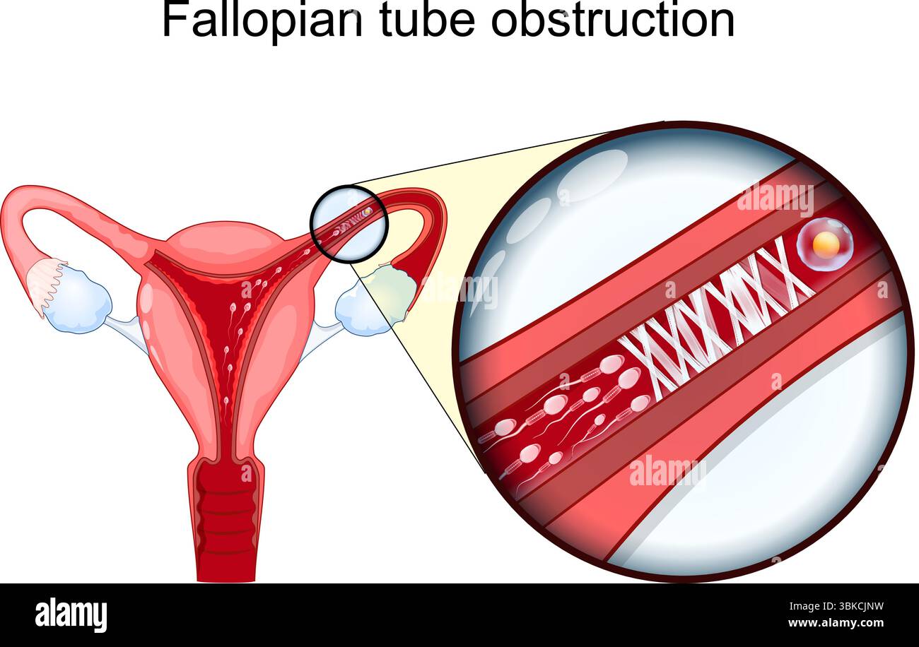Ostruzione della tuba di Falloppio. Infertilità femminile. Il primo piano delle tubature di Falloppio bloccate non è in grado di far convergere l'ovulo e lo sperma, fertilizzazione i. Illustrazione Vettoriale